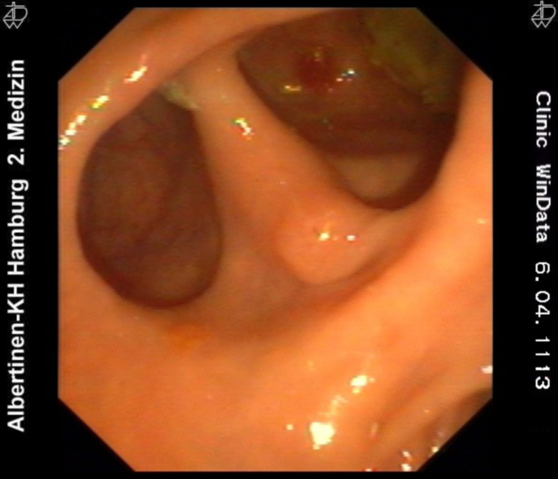 Double diverticulum at the papilla
