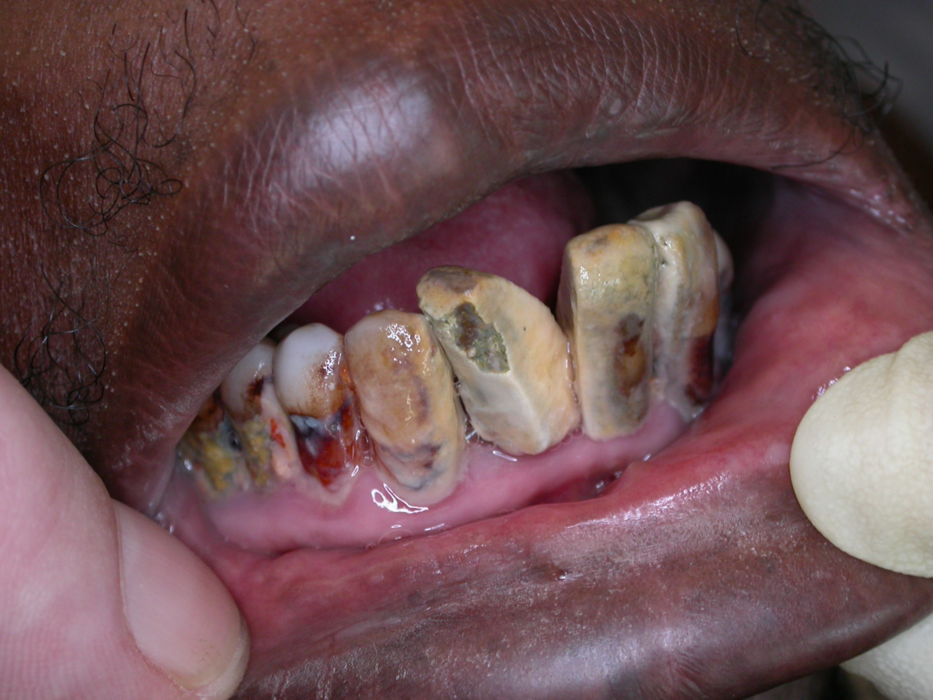 Neglected teeth
