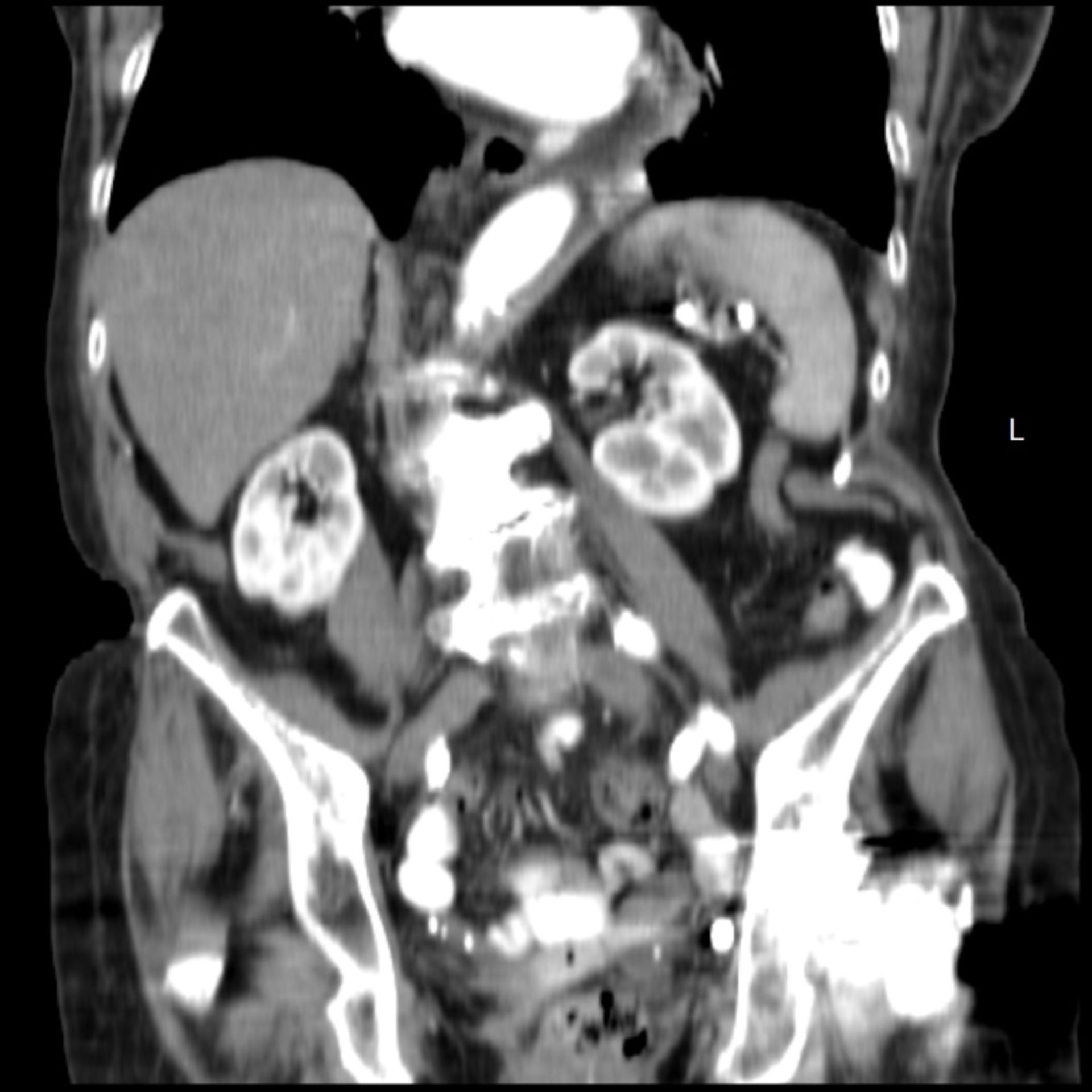 ct_abdomen3: CT des Abdomens in frontaler Ebene