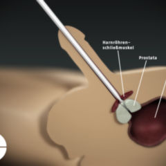 Operatie Adenom de Prostata, Erecție după turp
