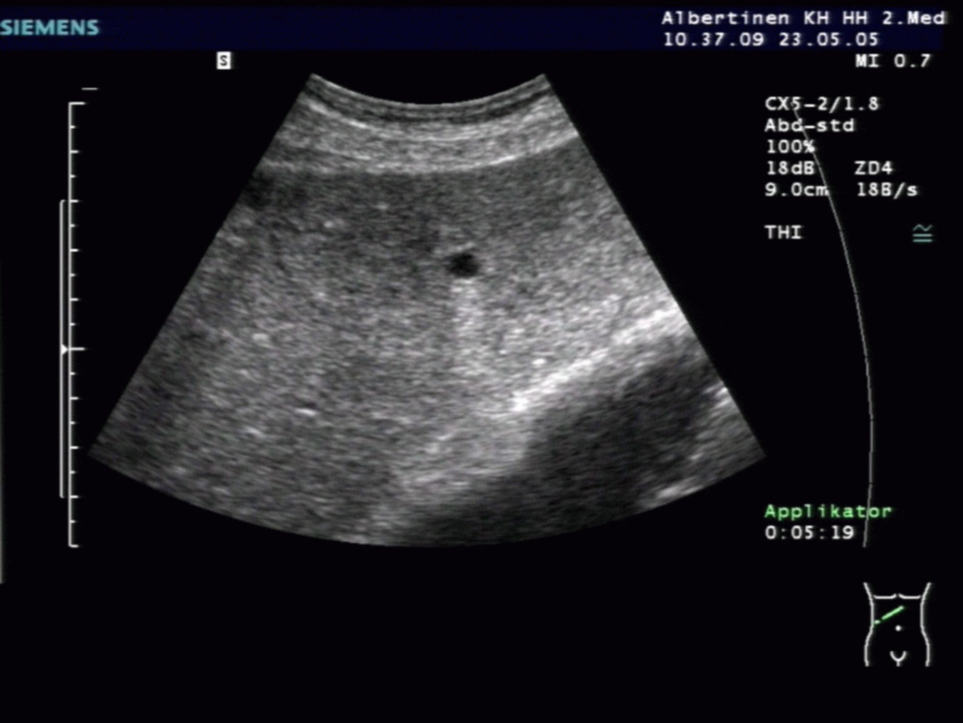 Liver cyst2