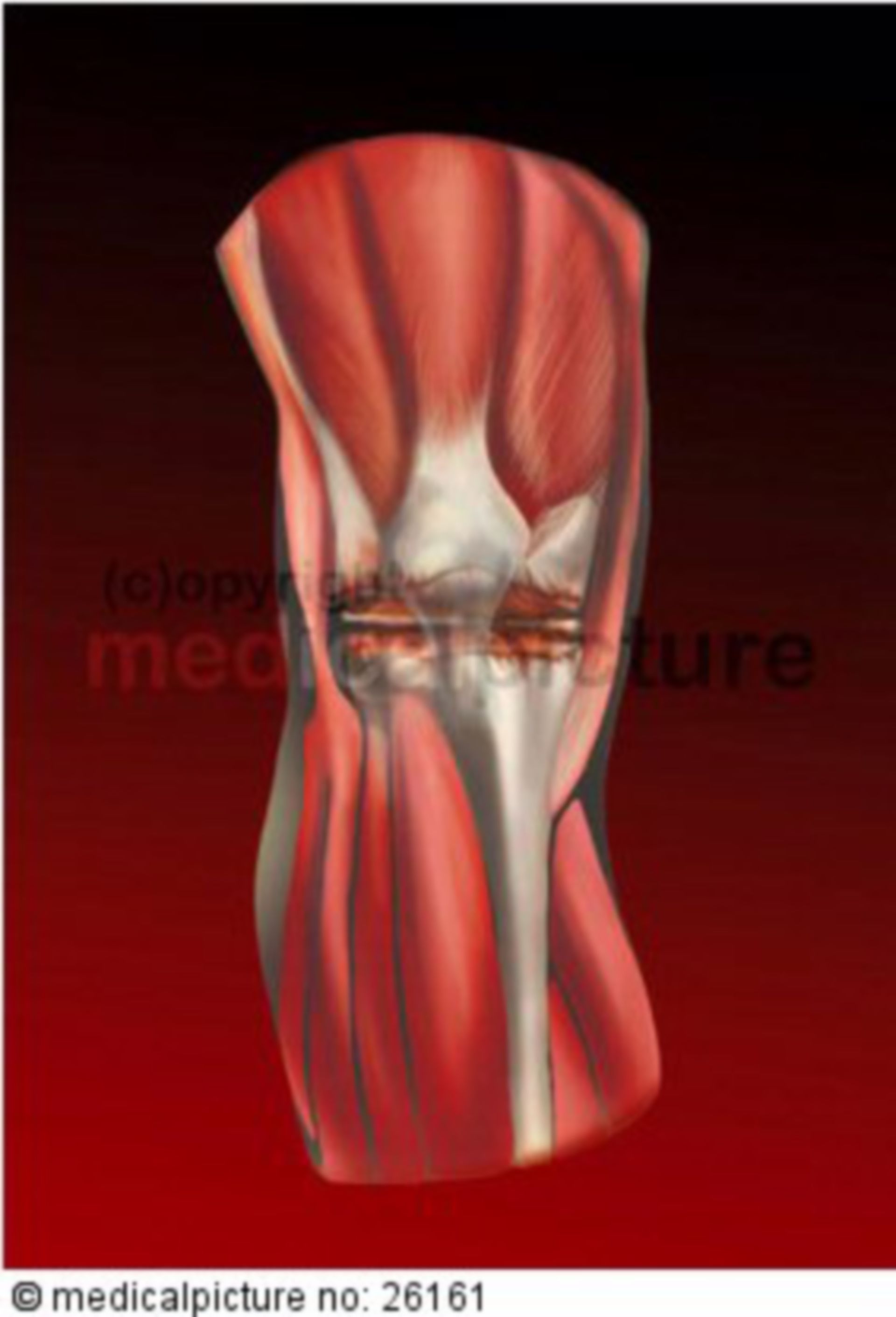 Arthritic Knee Joint