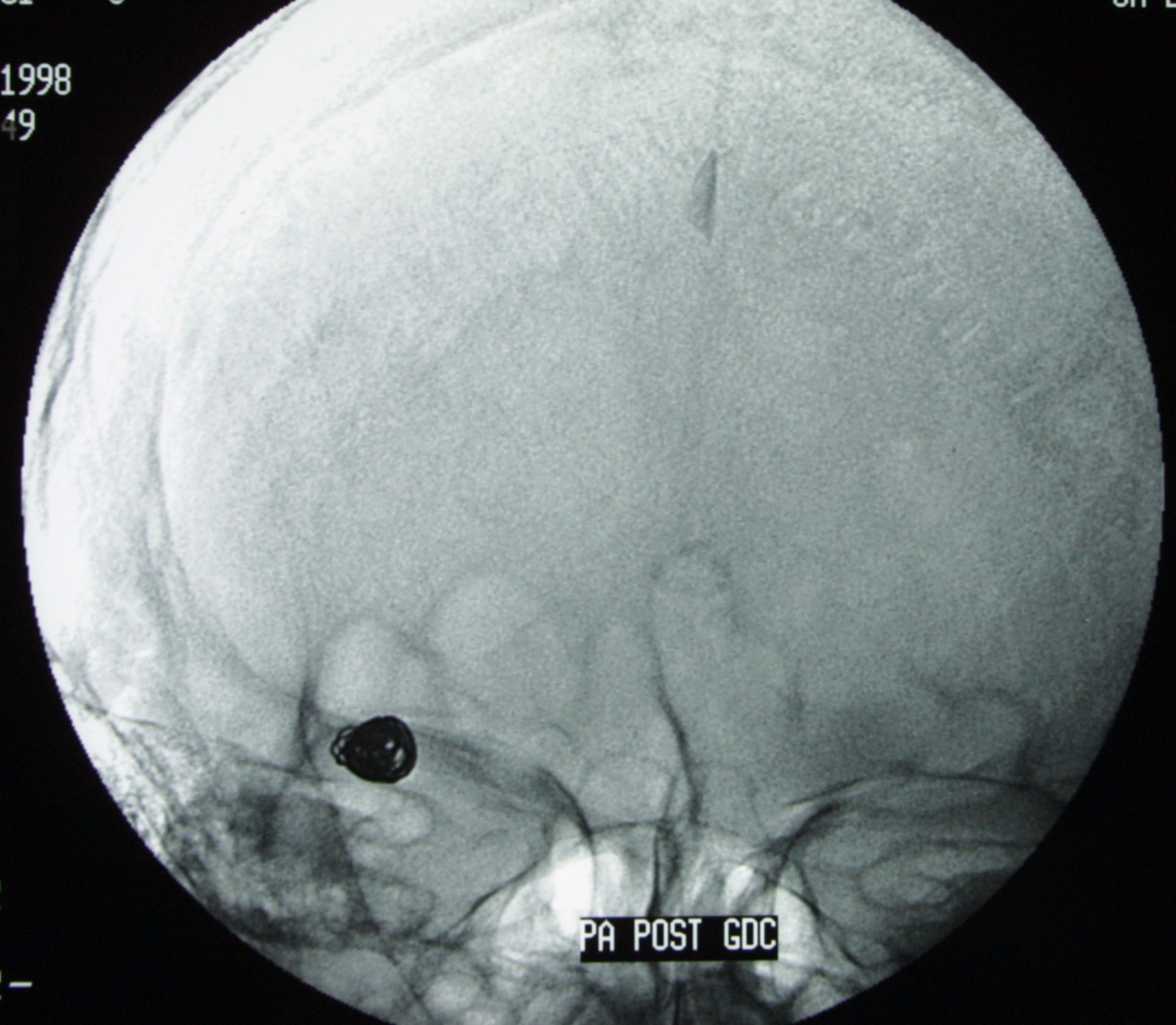 Coiled aneurysm - x-ray sideview