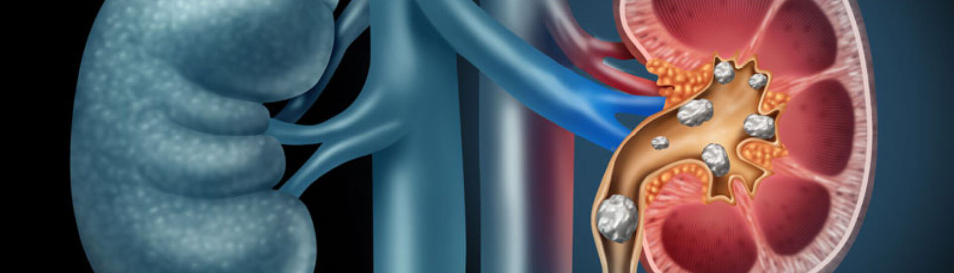 Neueinführung Thiola bei Cystinurie DocCheck