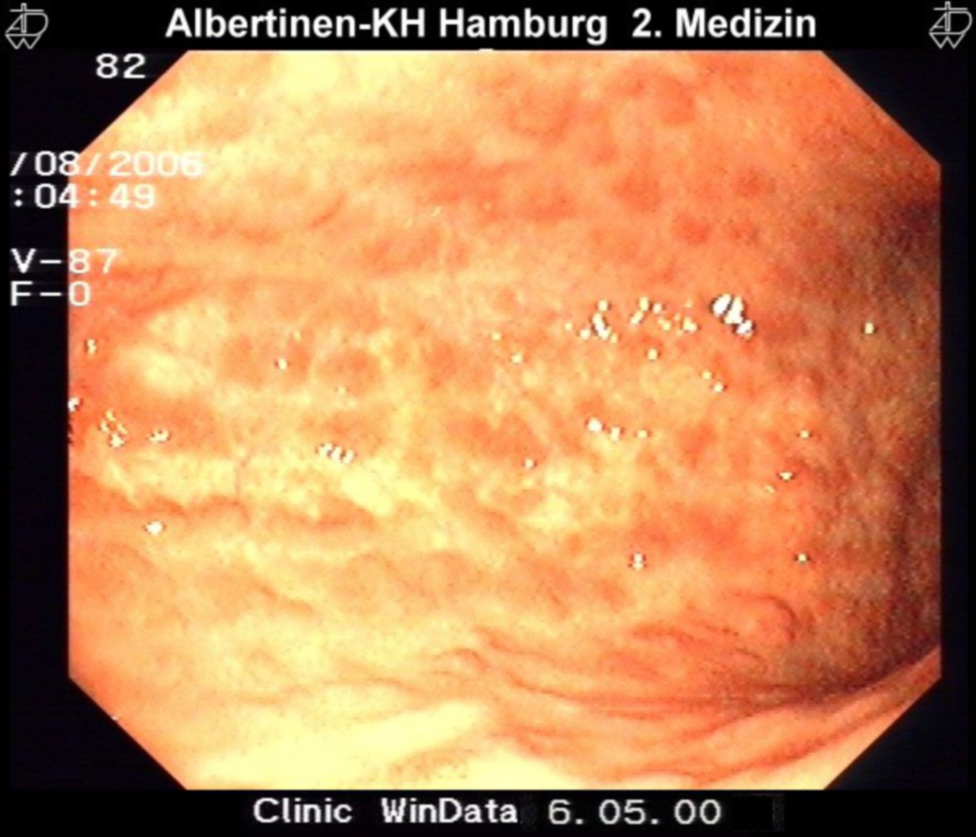 Blotchy-like atrophy of the gastric mucosa