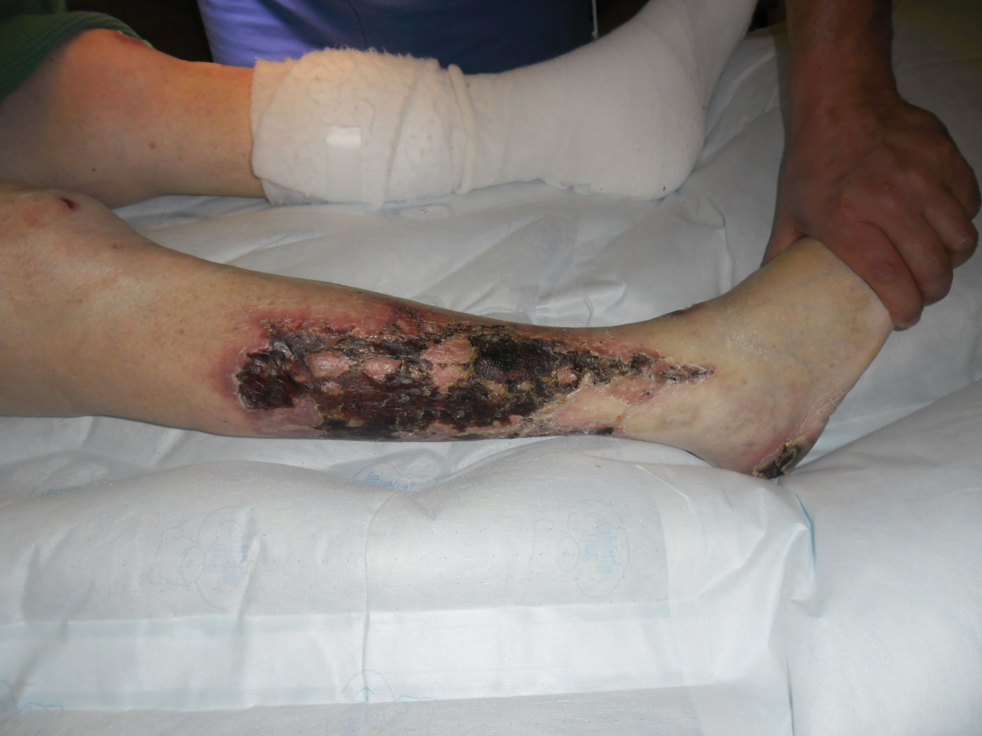 Arterial occlusive disease stage 4 - Calciphylaxis