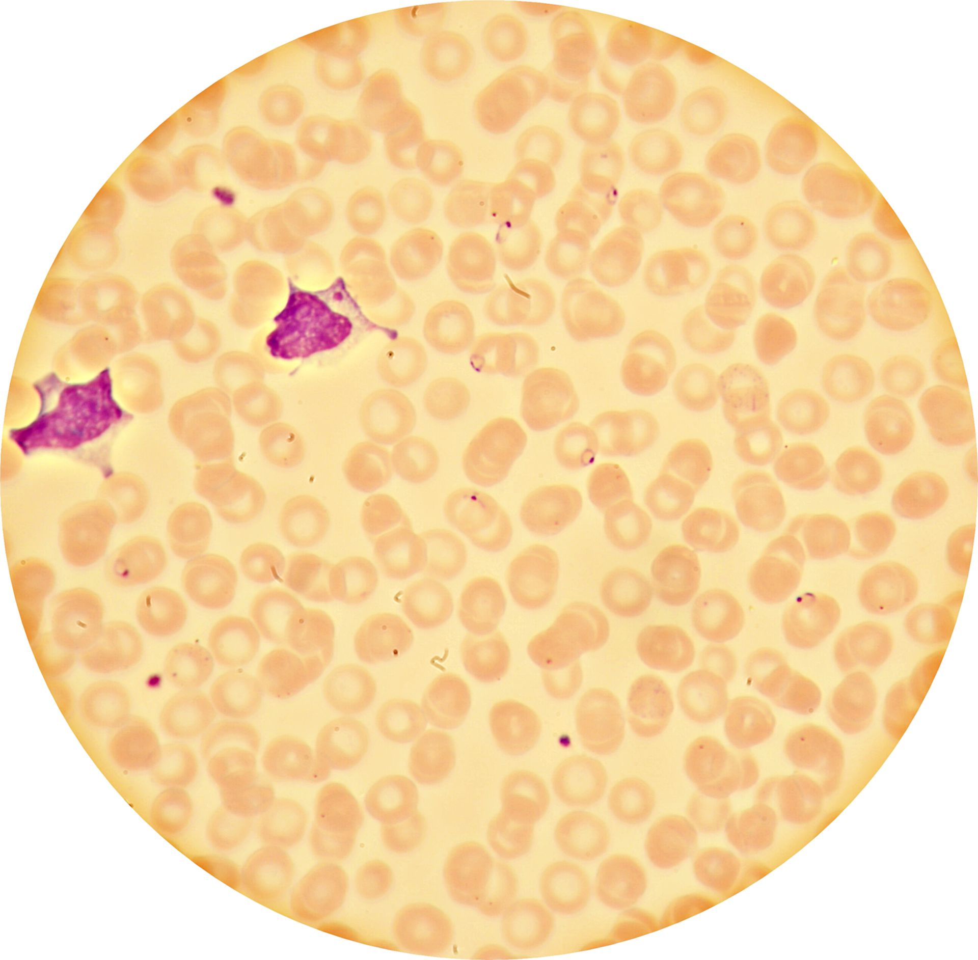 Malaria tropica (blood smear)