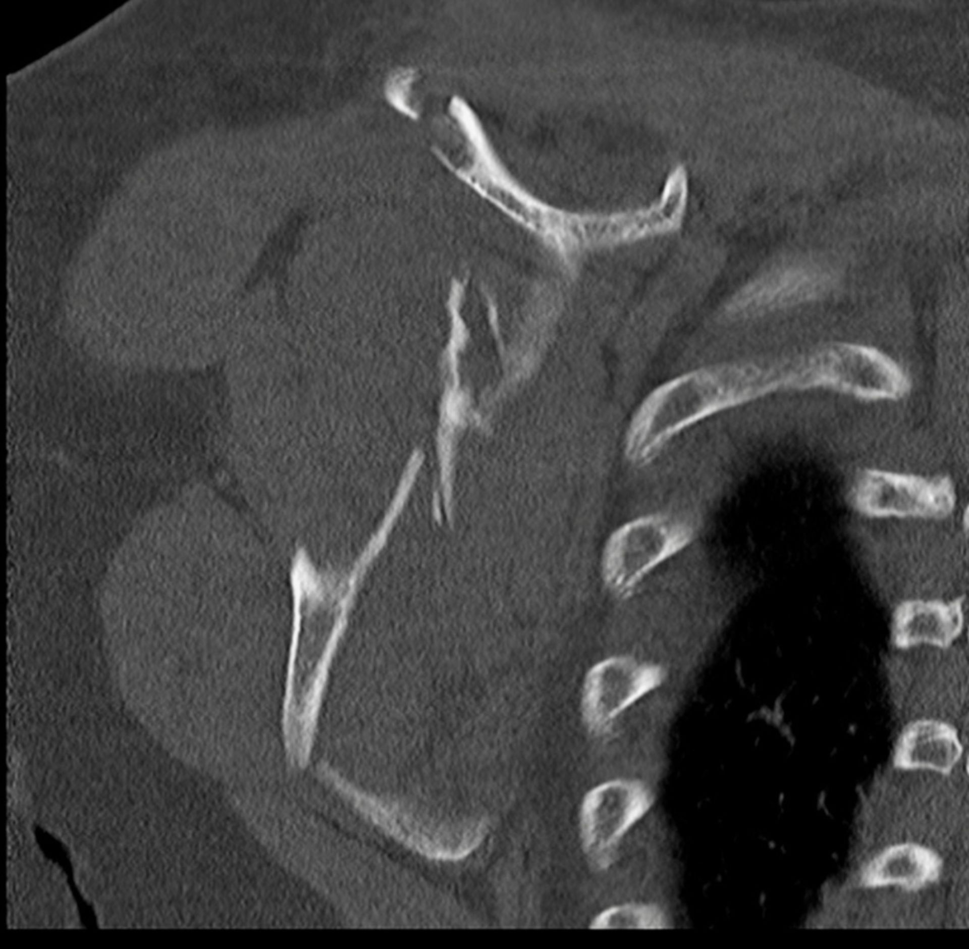 CT des Schultergürtels mit Scapulatrümmerfraktur
