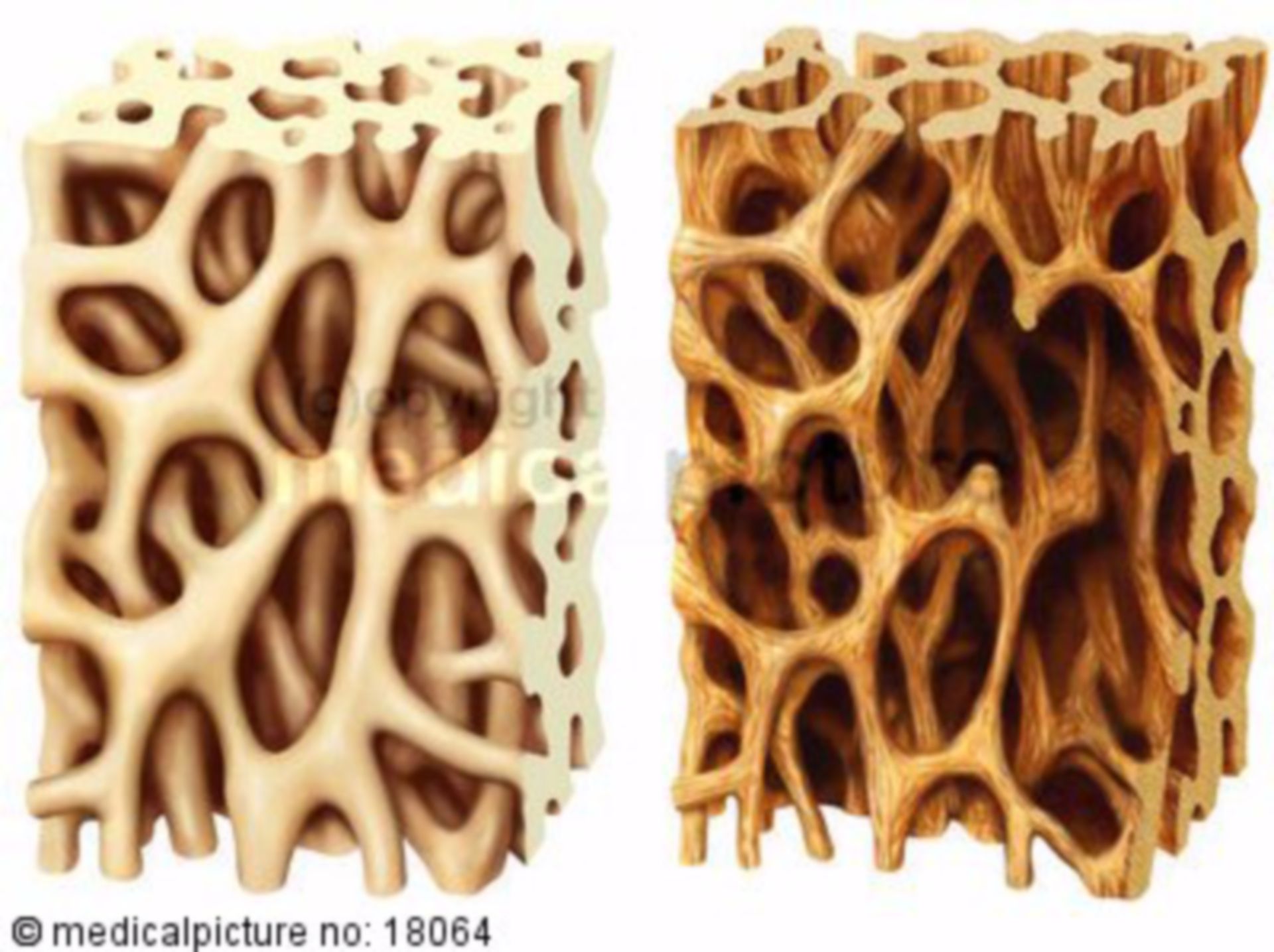 Healthy Bone Vs Osteoporosis DocCheck