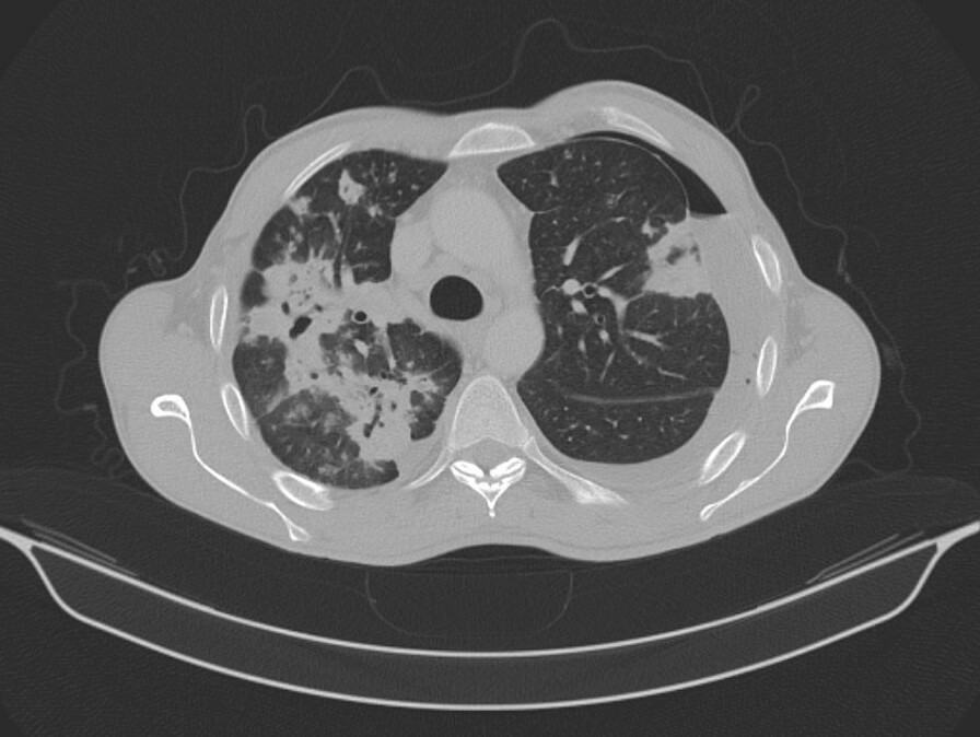 doccheck_-_07_-_komplexe_lungeninfektion_bild5_tbc_original.jpg