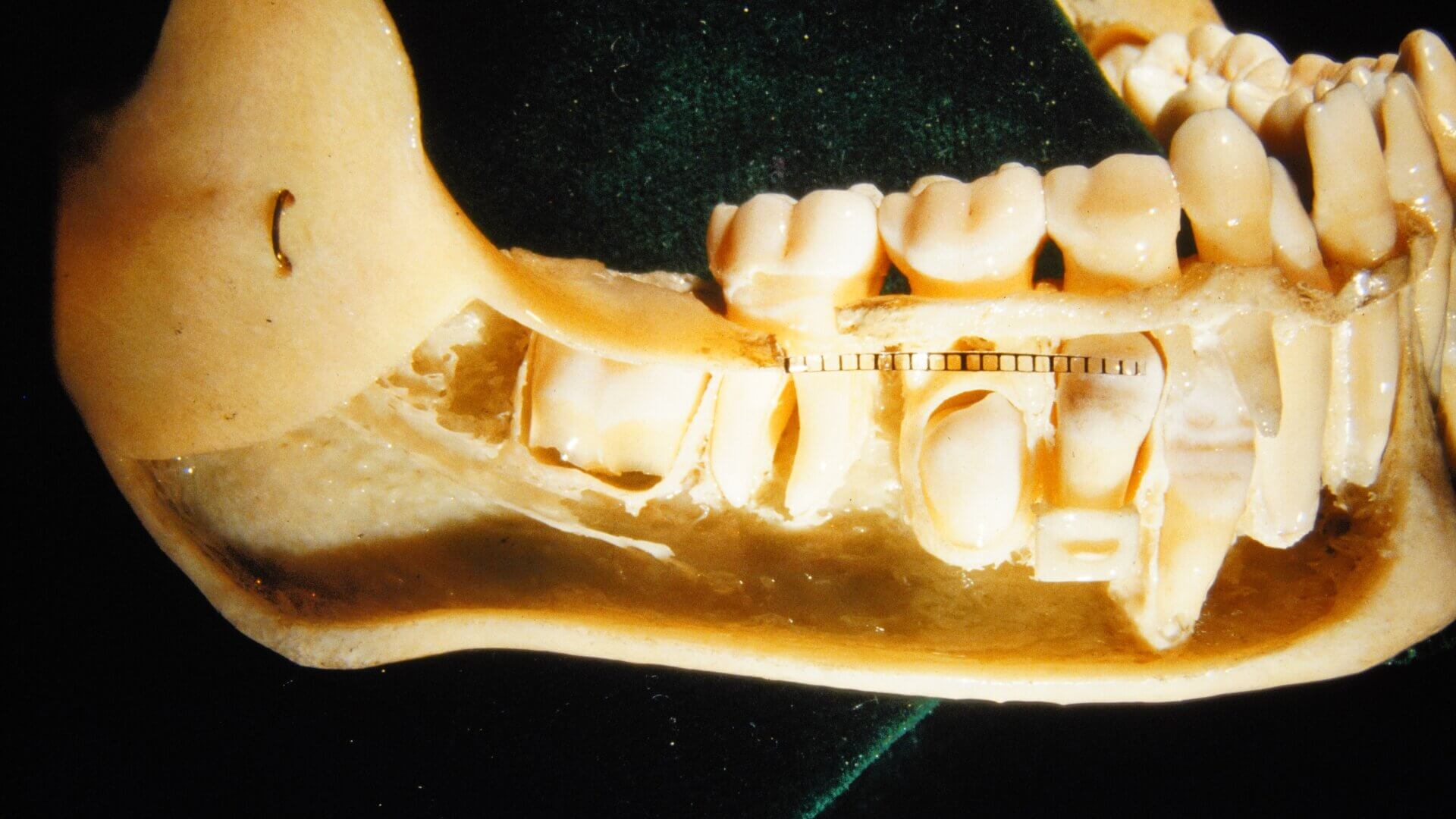 Mandibula