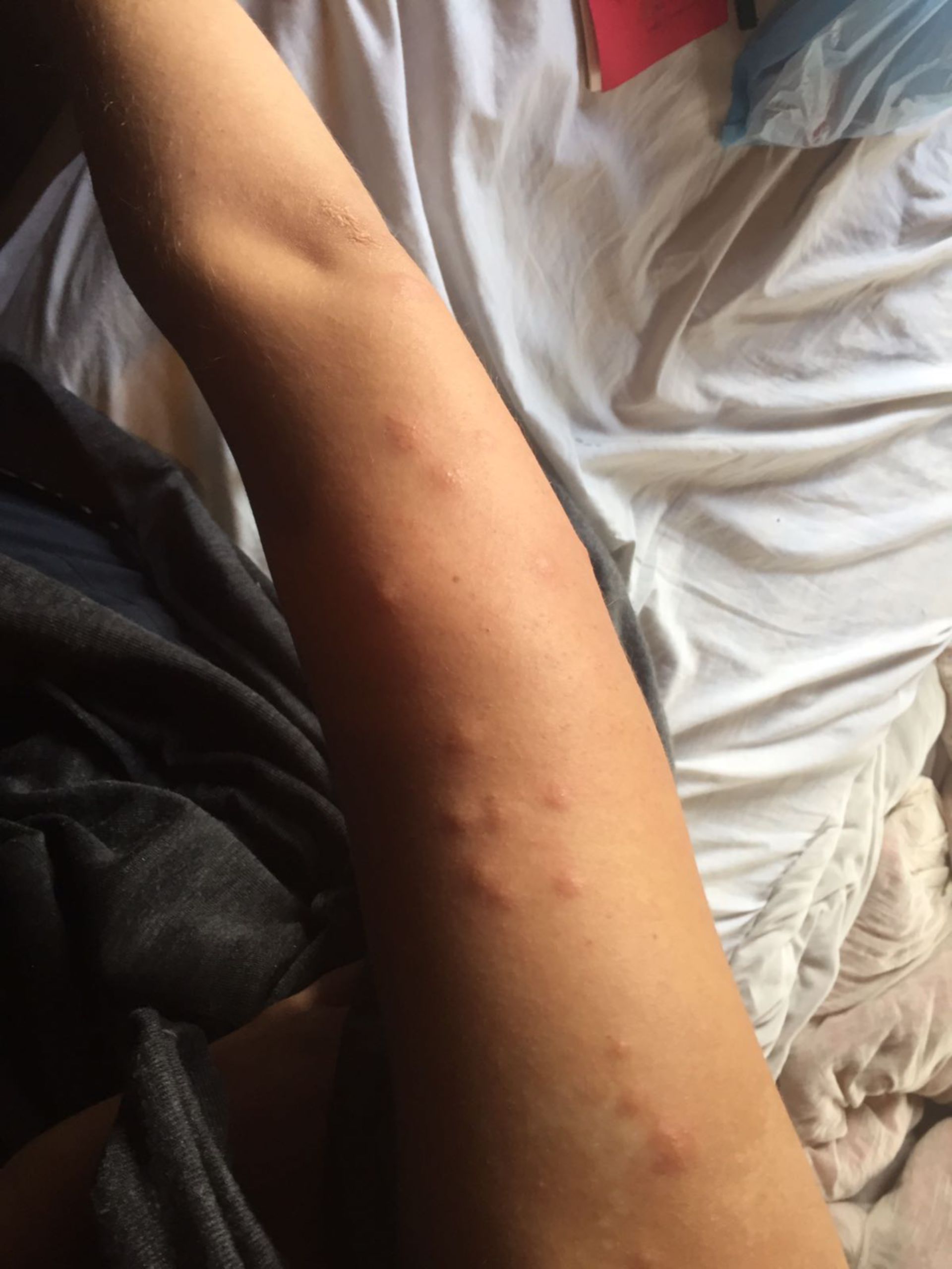 Arm with skin irritation