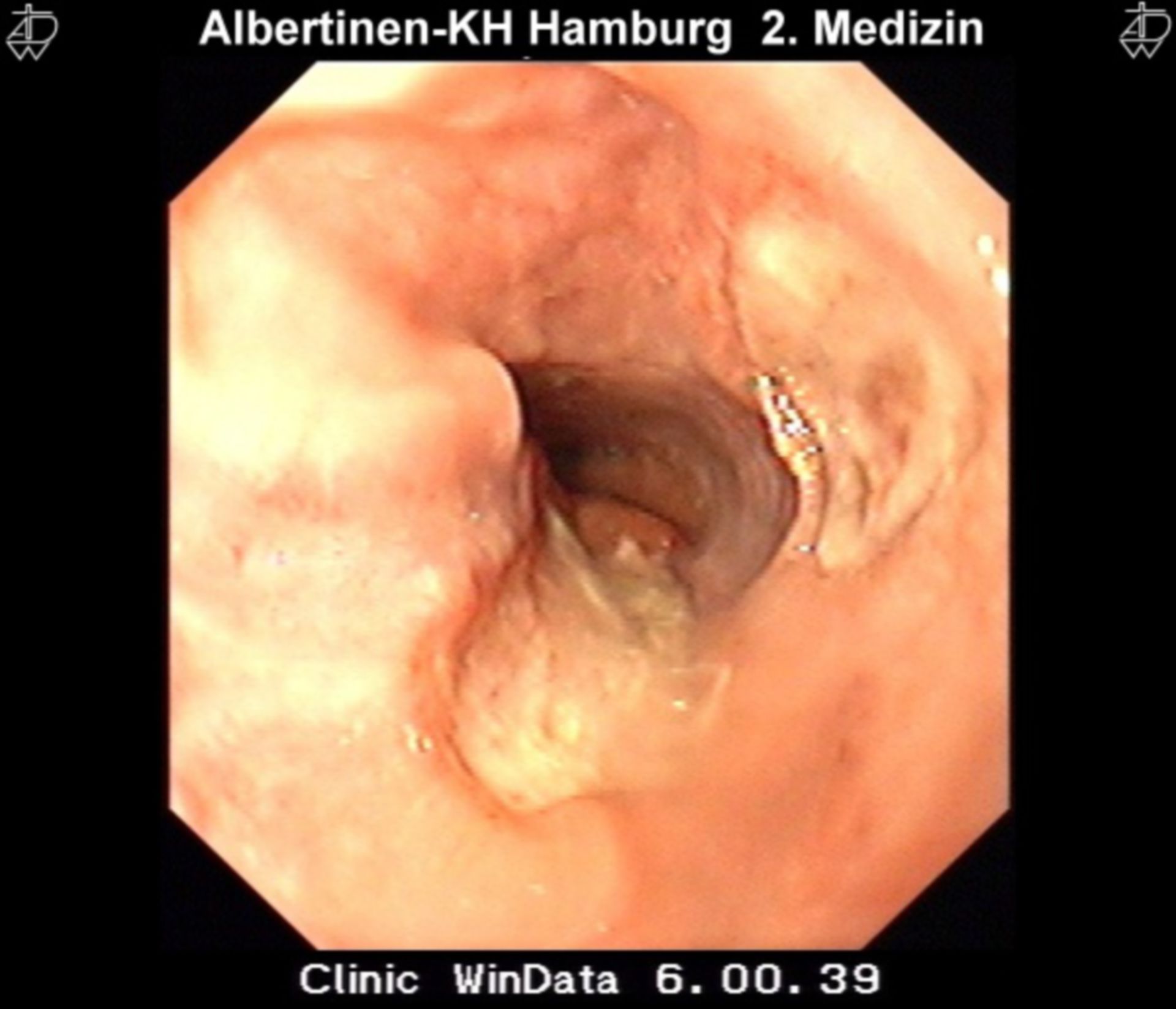 Ligation of an ulcer