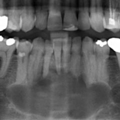 Keratozystischer Odontogener Tumor Doccheck Flexikon