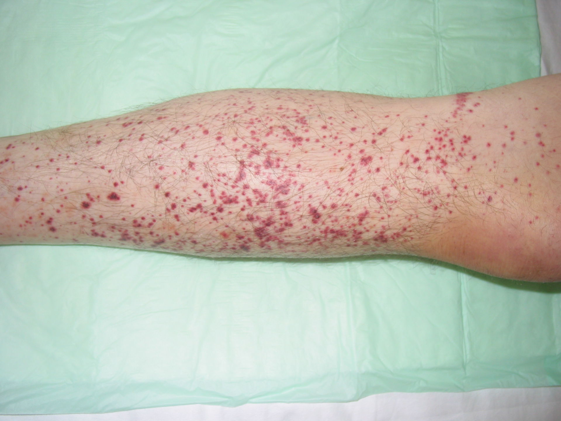 Patient with vasculitis and resulting petechia