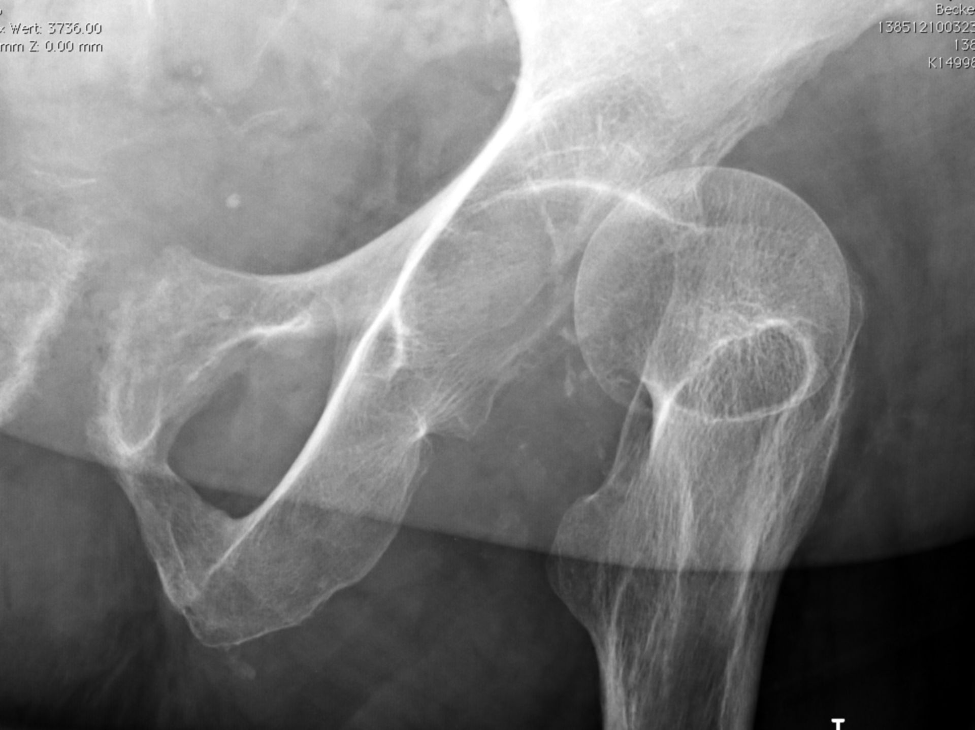 Hip luxation