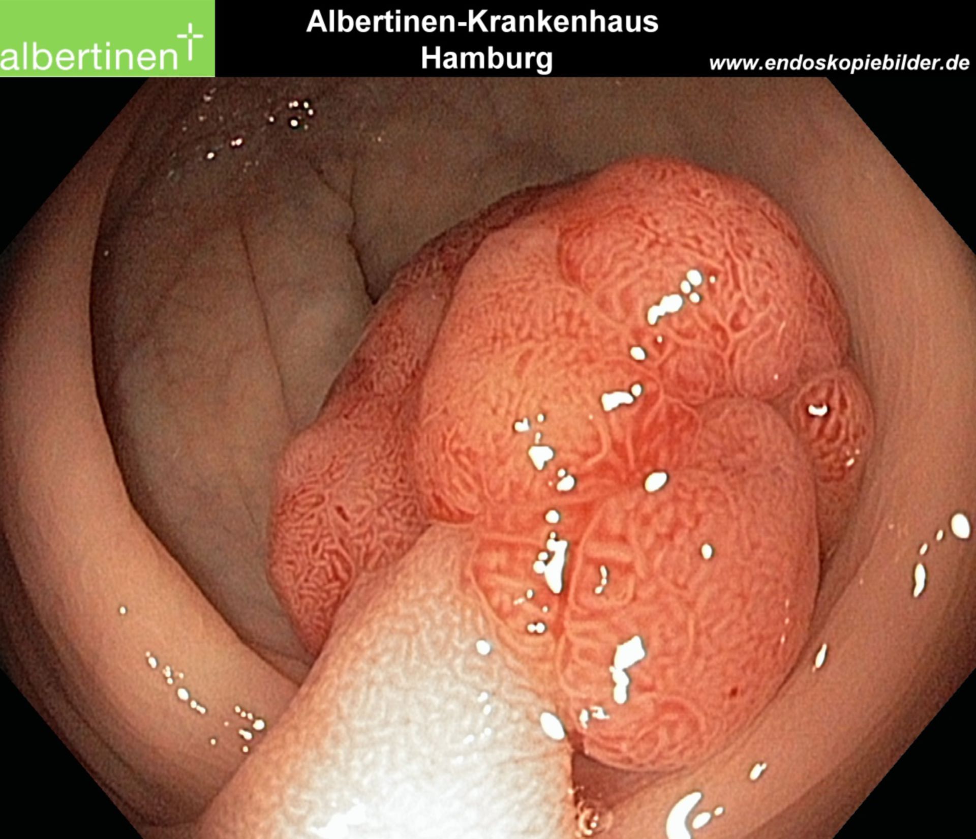 Endoscopy: Large Polyp in the Colon
