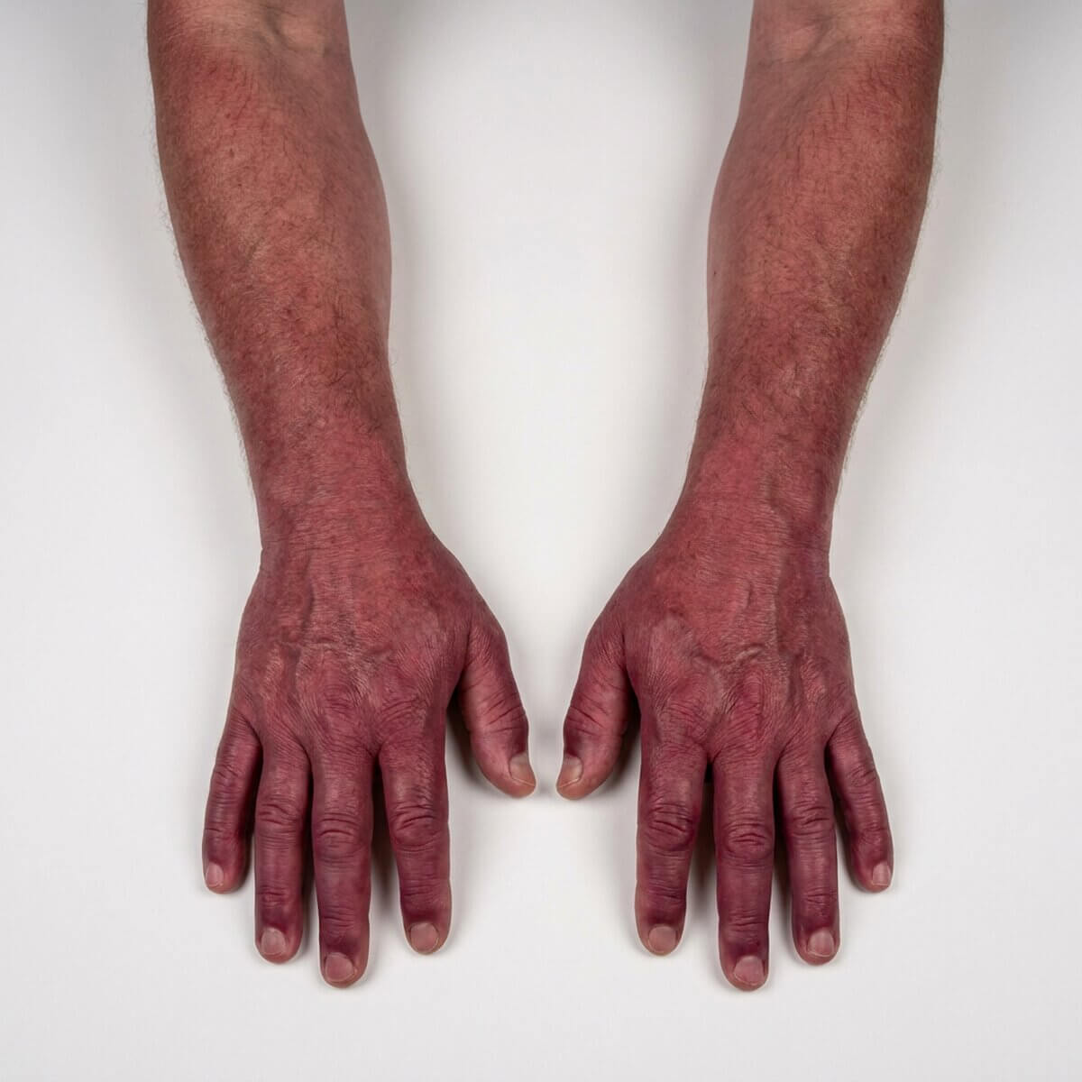Erythromelalgie bei Polycythaemia vera