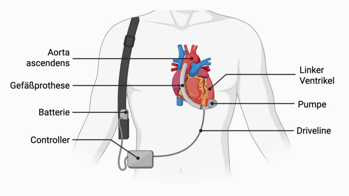 Linksventrikuläres Herzunterstützungssystem (LVAD)