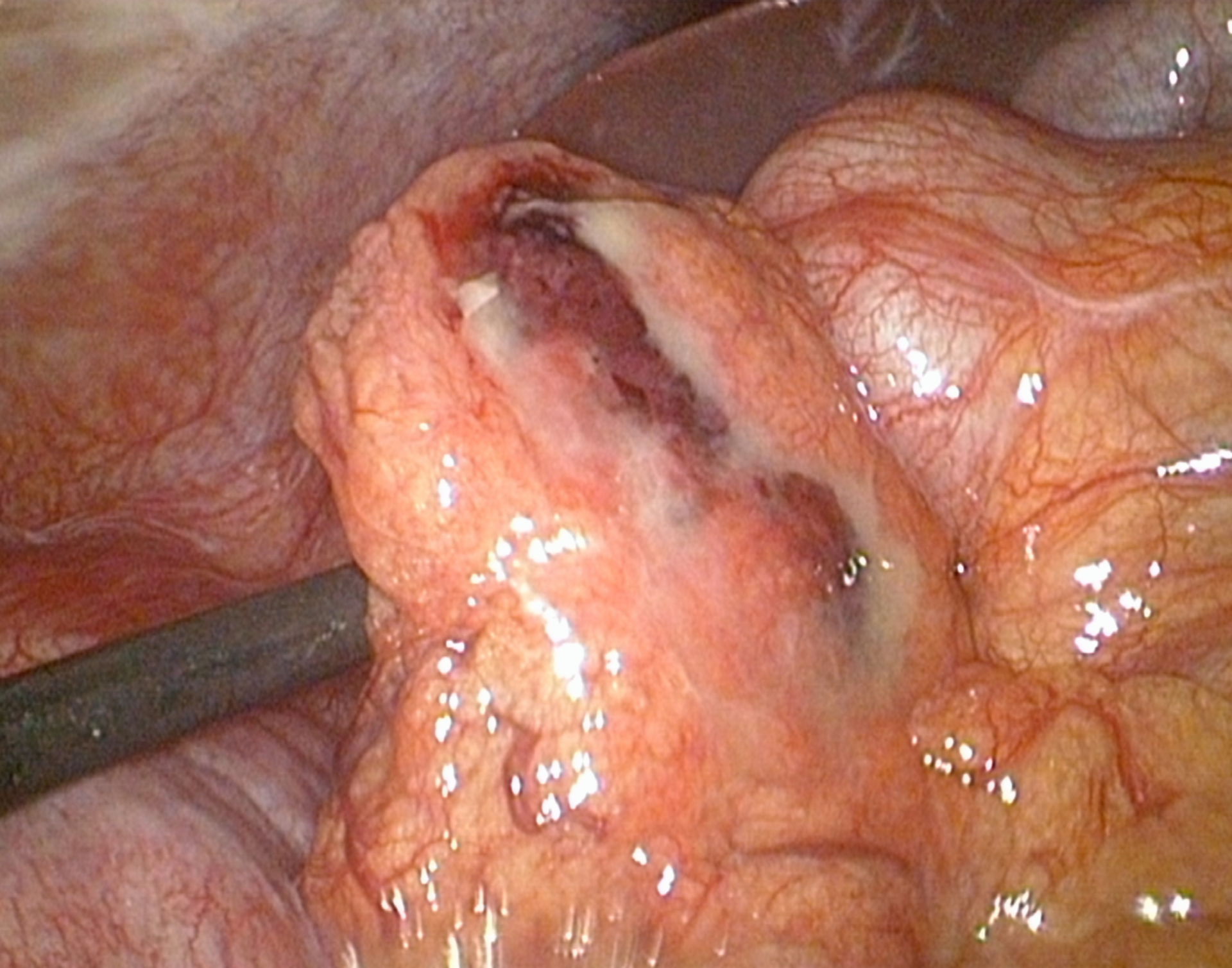 Entzündlicher Tumor Omentum majus bei einem Kind