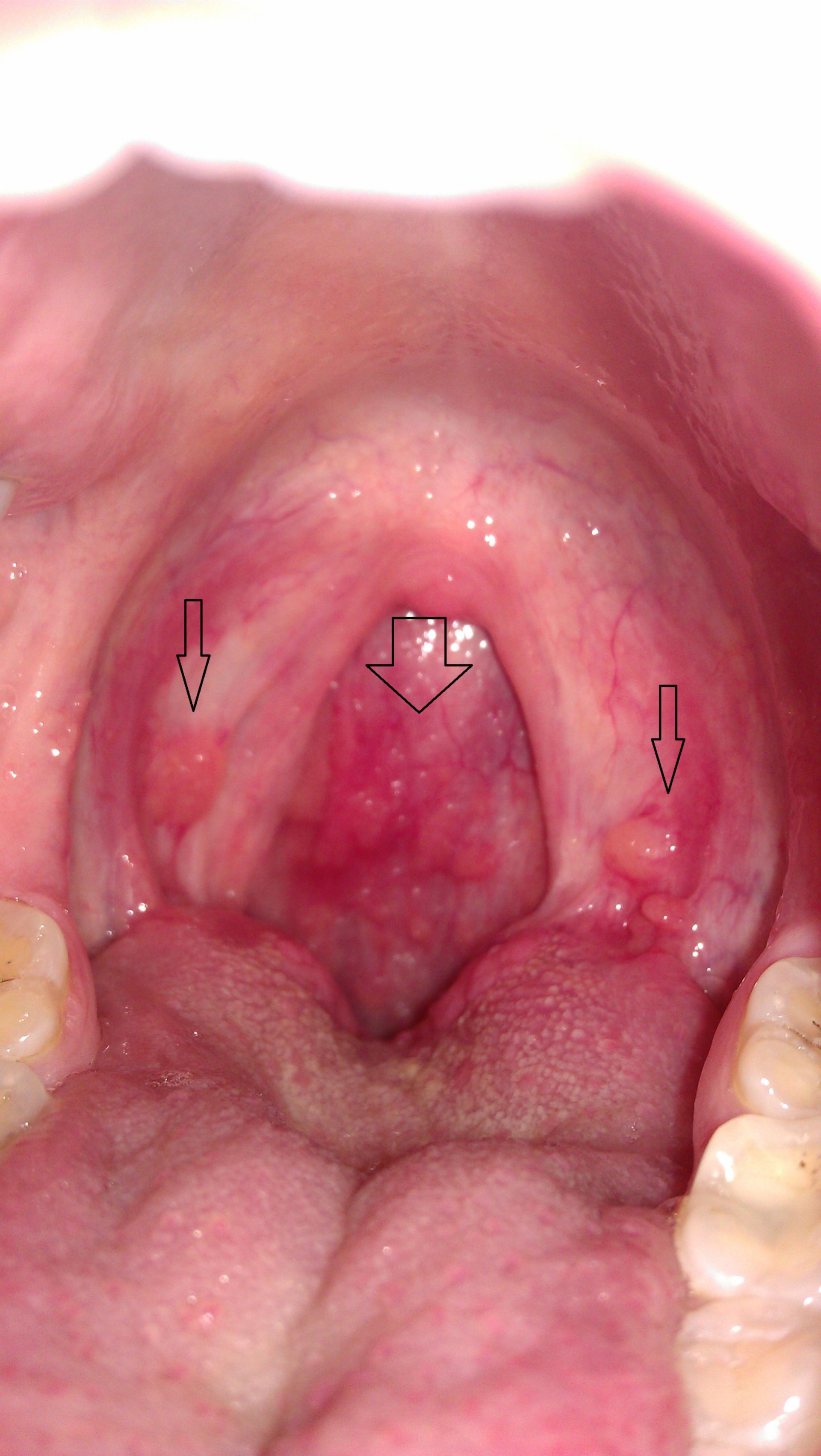 Reoccuring painful oral mucosa abnormality