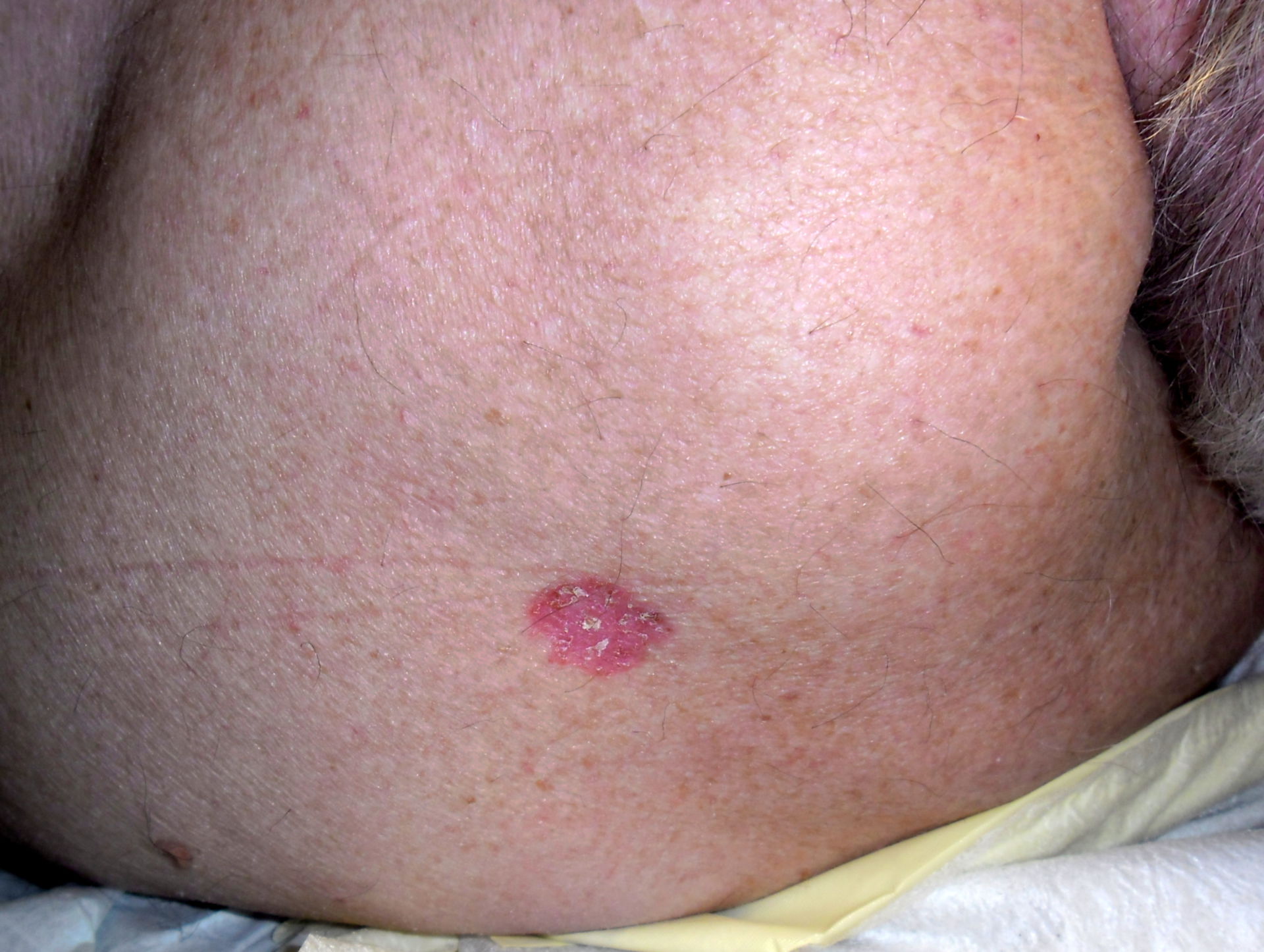 Carcinoma basocellulare sulla schiena