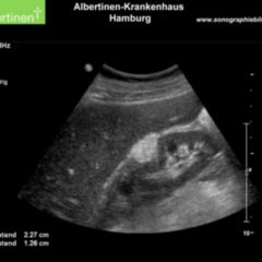 Angiom DocCheck Flexikon