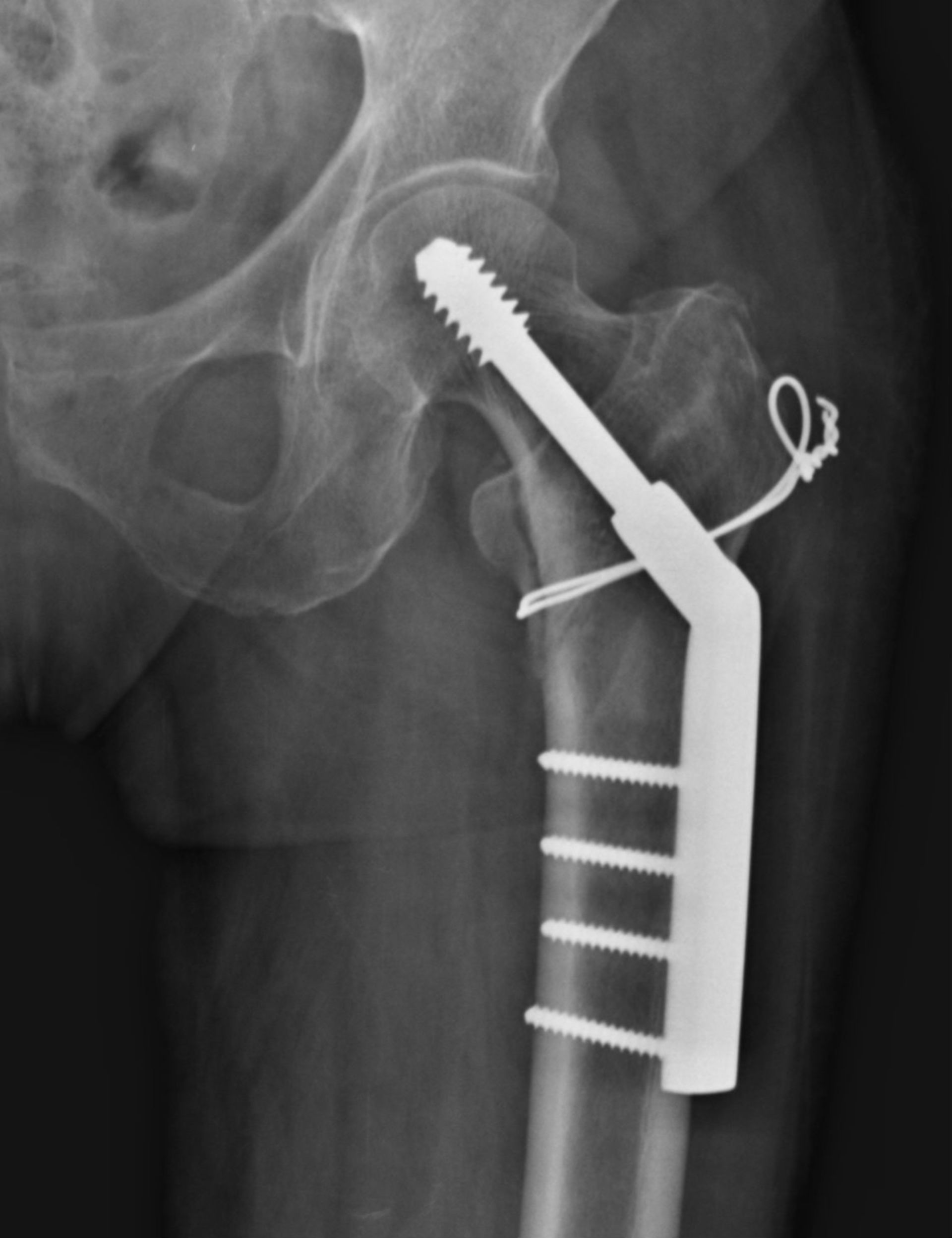 dynamic hip screw