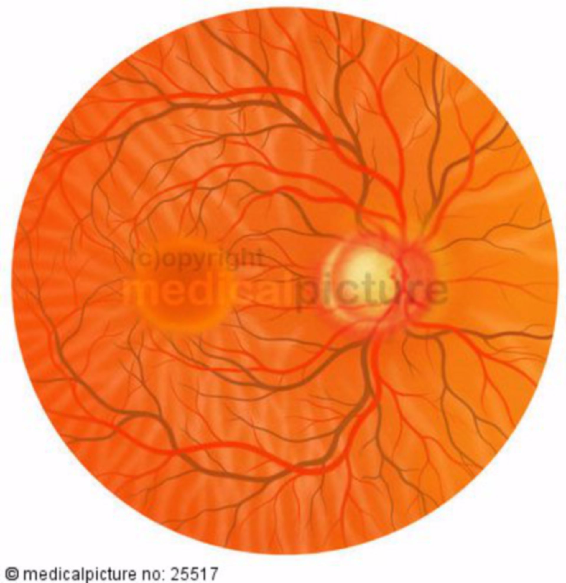 Augenhintergrundspiegelung bei Grünem Star, Glaukom