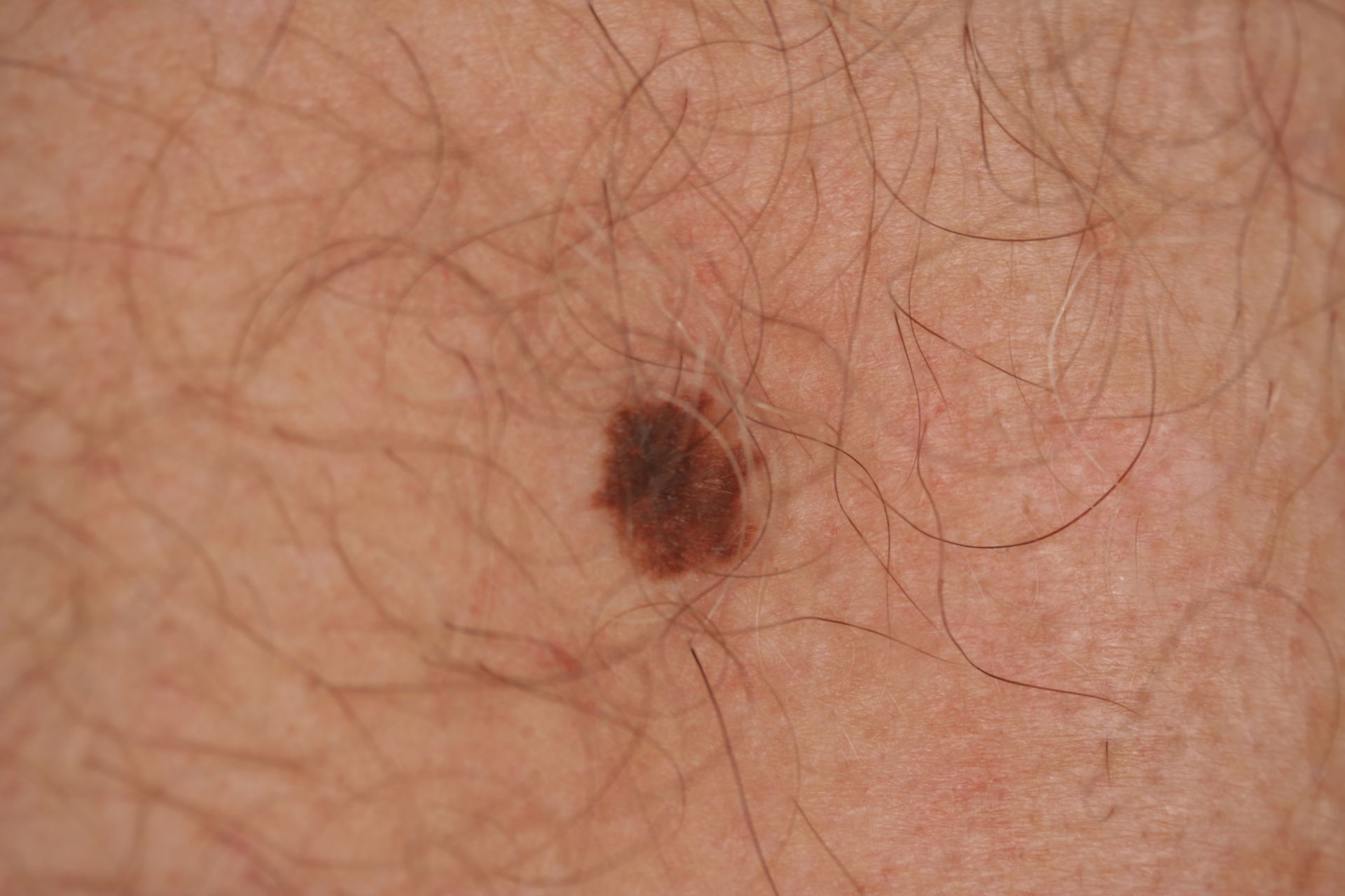 Skin cancer or melanoma?
