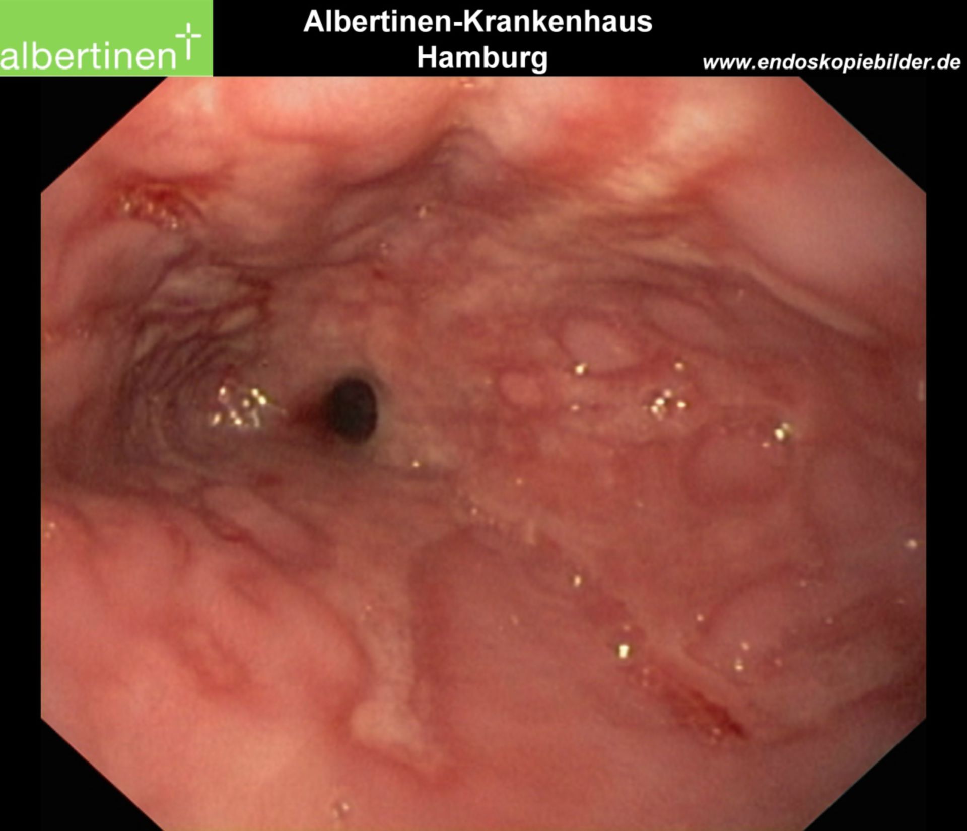 Esophagitis stage 4 with stenosis