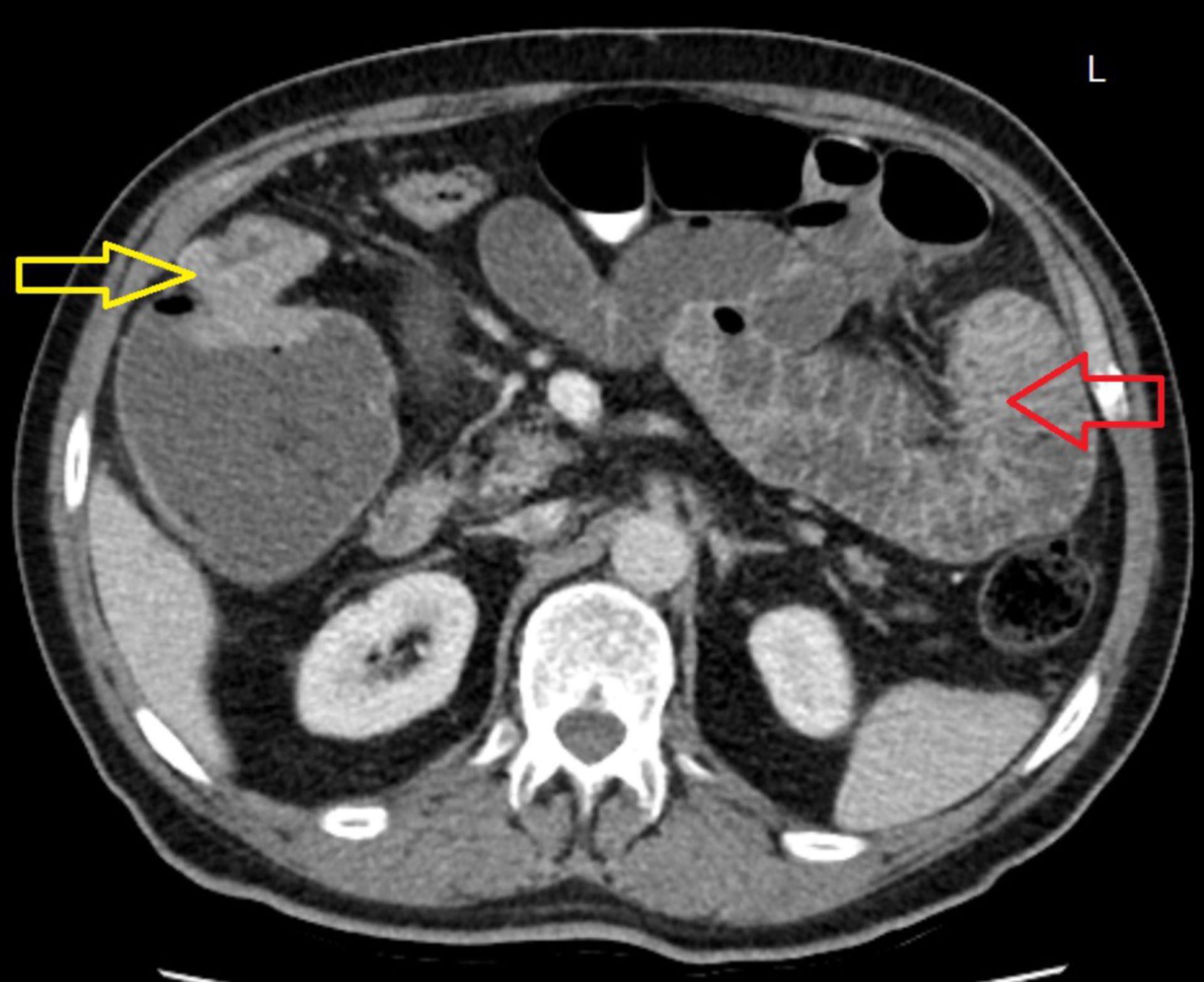 tra2: CT des Abdomens in transversaler Ebene