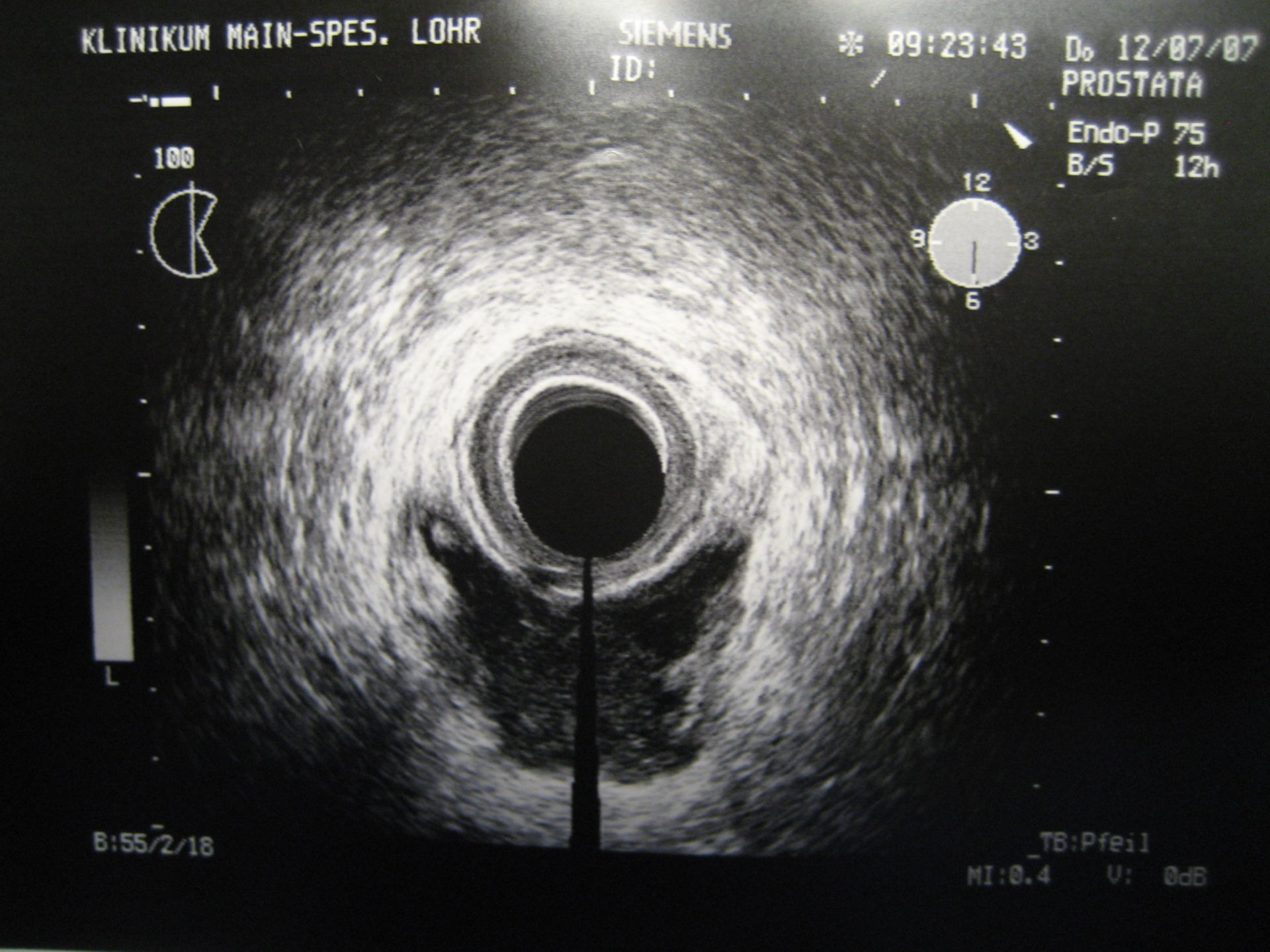 Abscess of the anal sphincter - endoscopic ultrasound