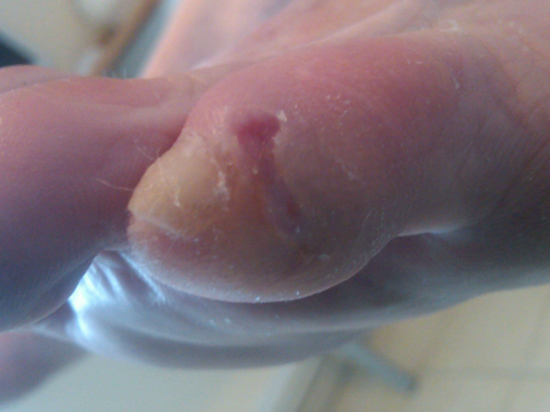 exposed wound of the toe