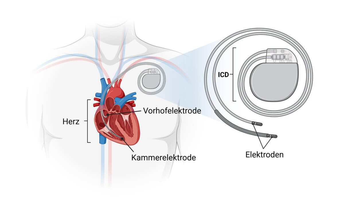 Implantierbarer Kardioverter-Defibrillator (ICD)