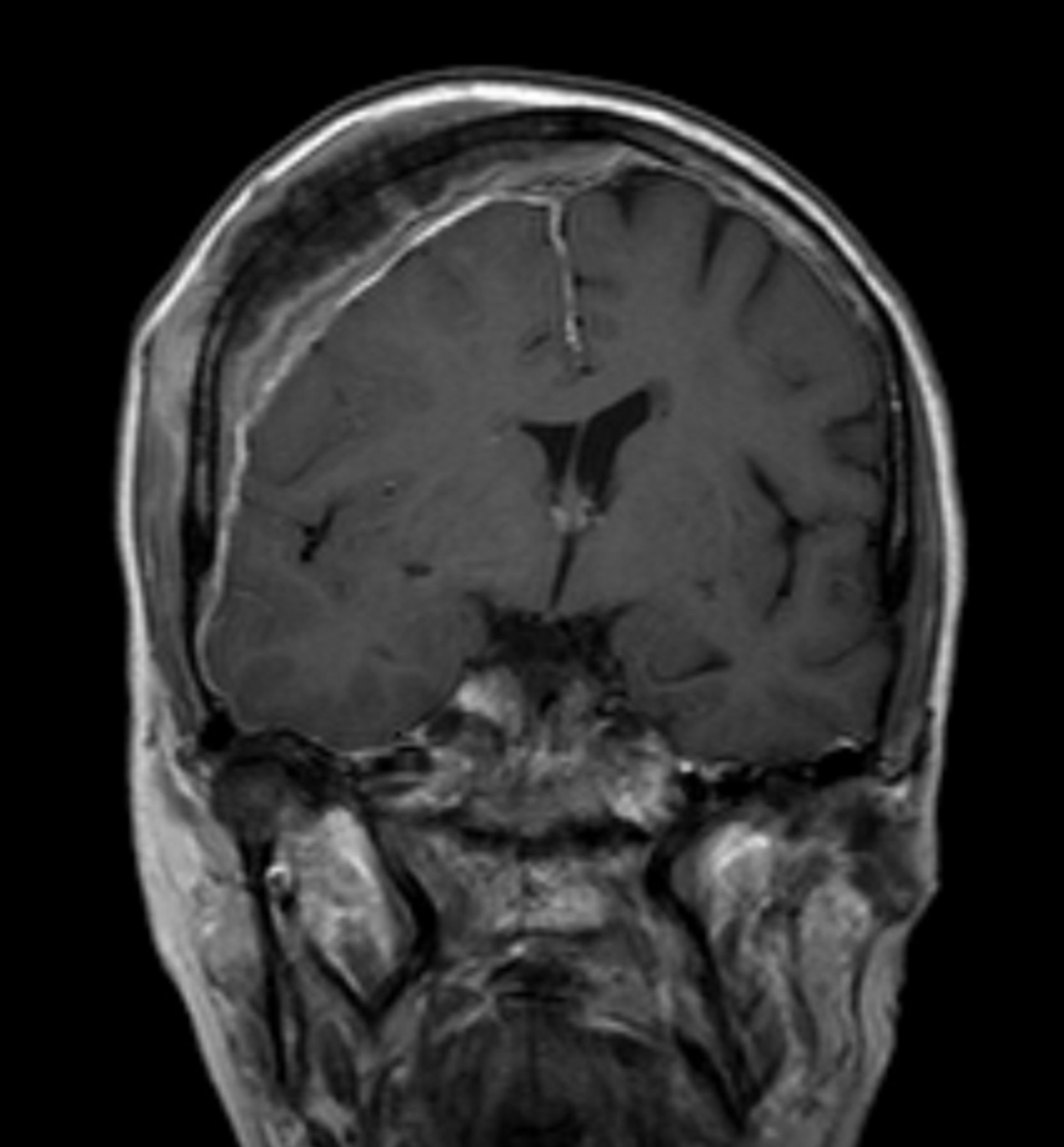 Prostate-carcinoma - osseus metastases of cranial roof (MRI, T1)