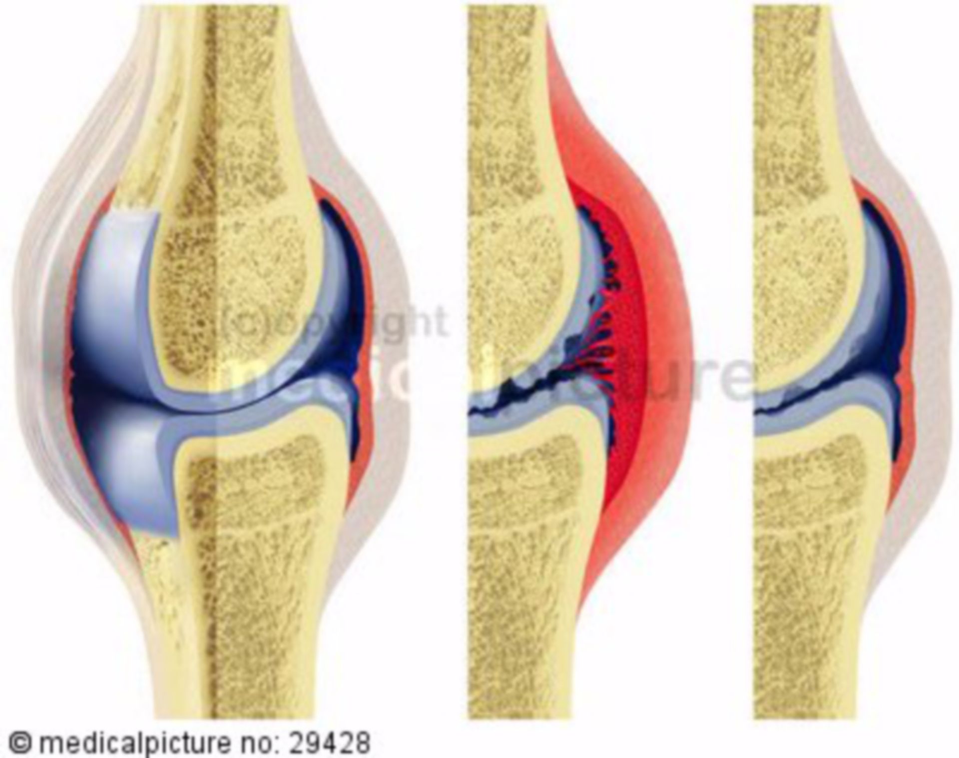  Entstehung und Verlauf der rheumatoiden Arthritis unter Therapie 
