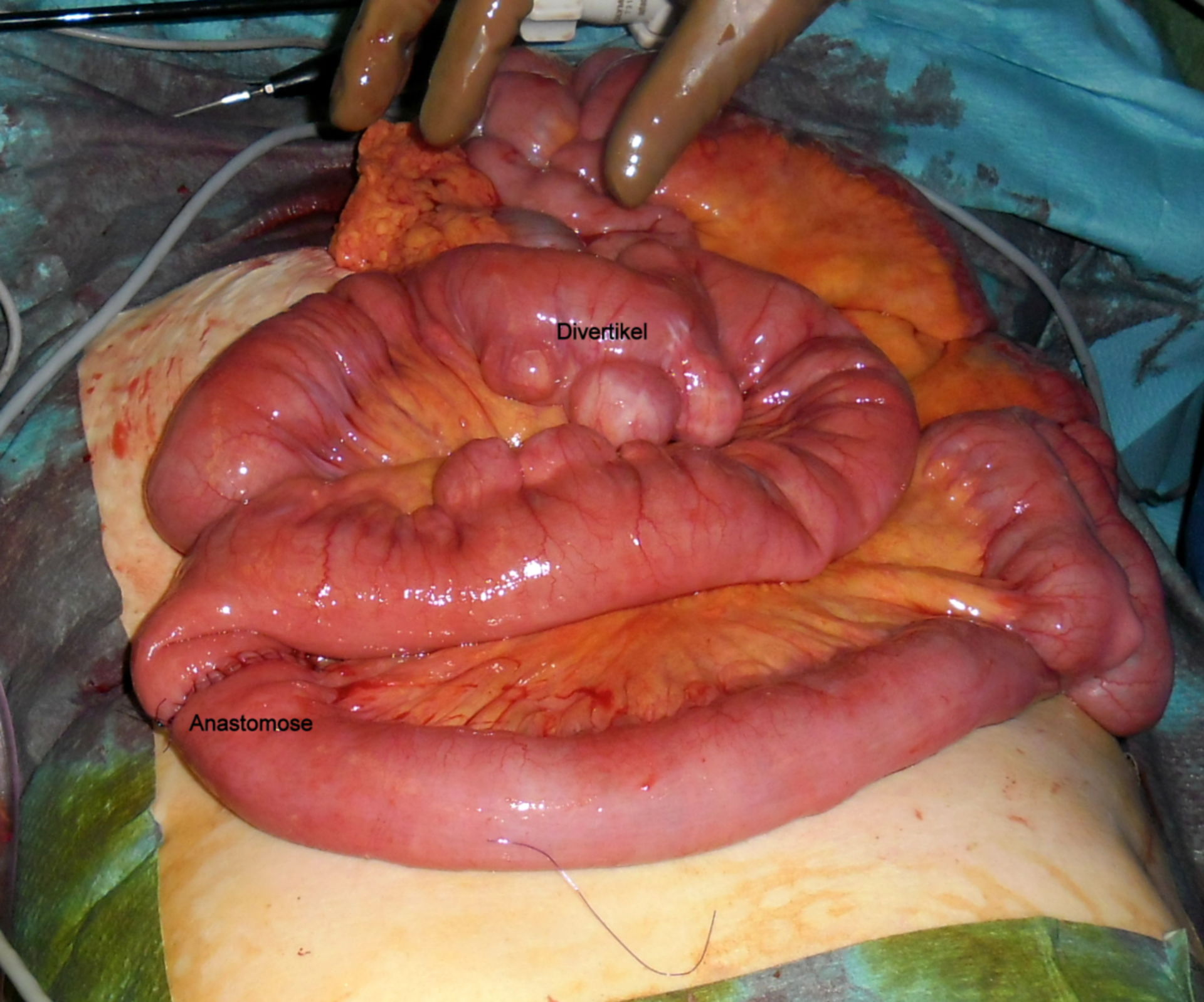 Diverticolite dell'intestino tenue con perforazione - presentazione dopo la resezione