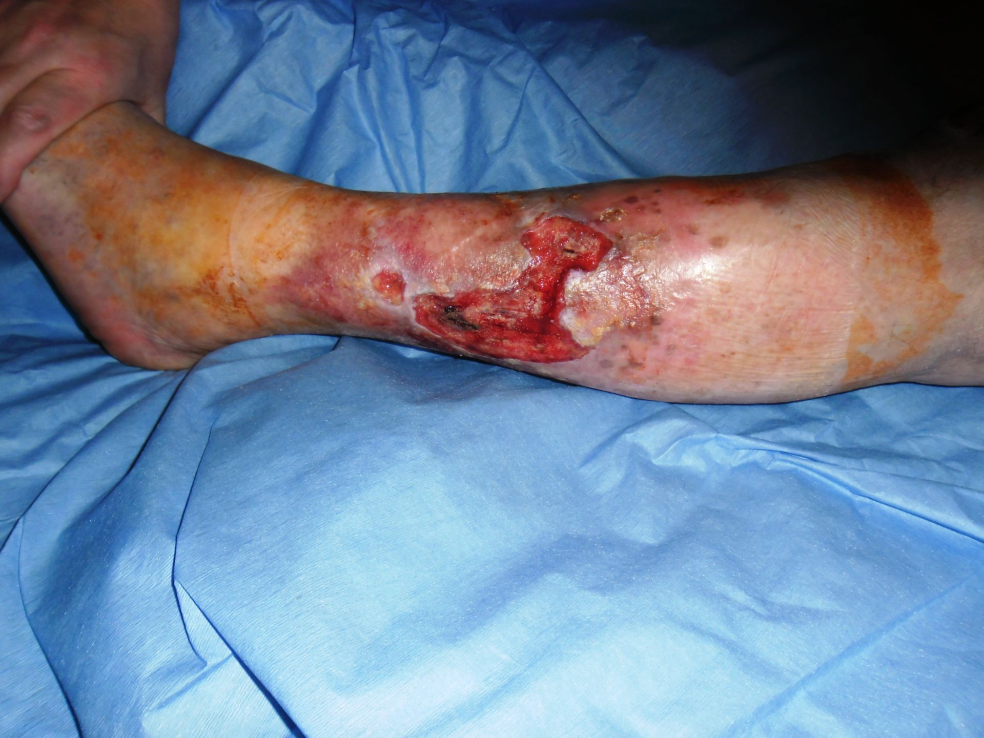 Ulcera varicosa
