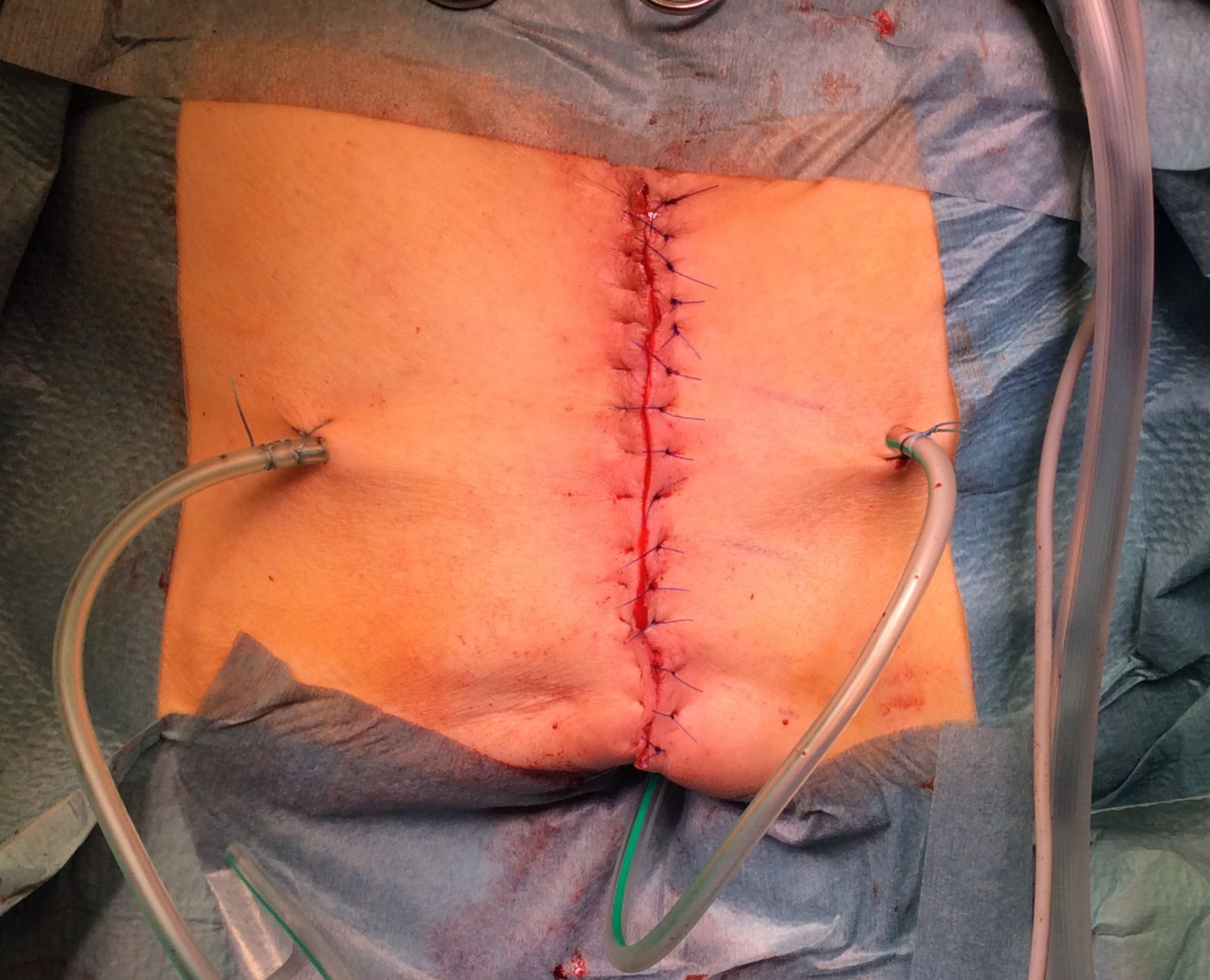 Sacral hernia after rectal extirpation – situs after closure of the skin
