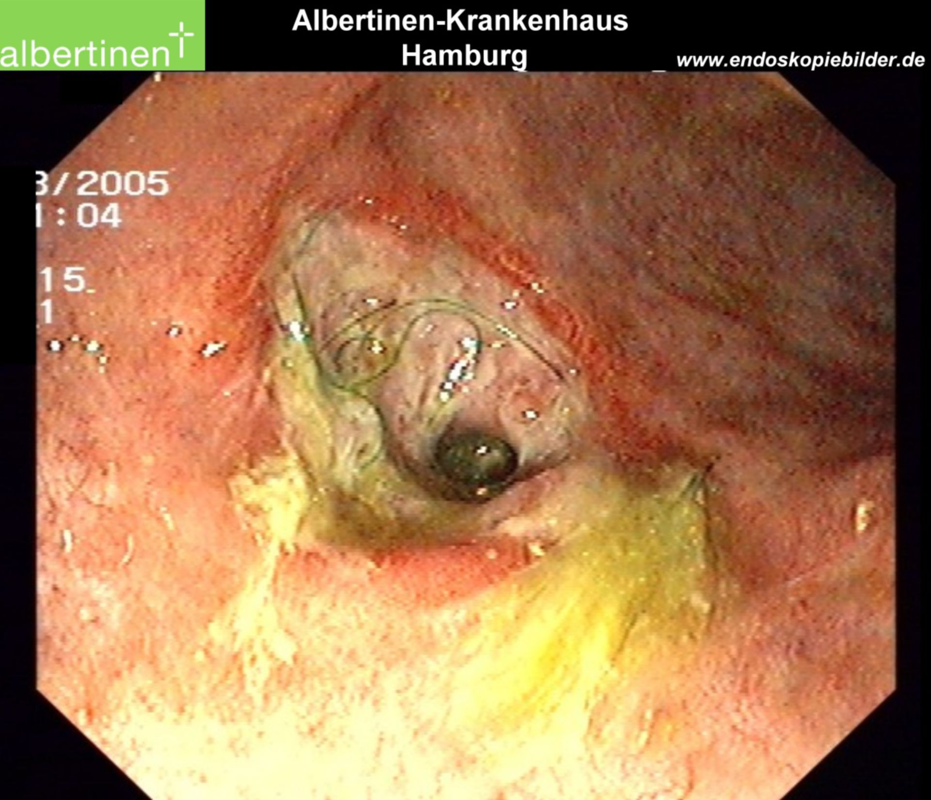 Endoscopy Crohn's Disease Fistula