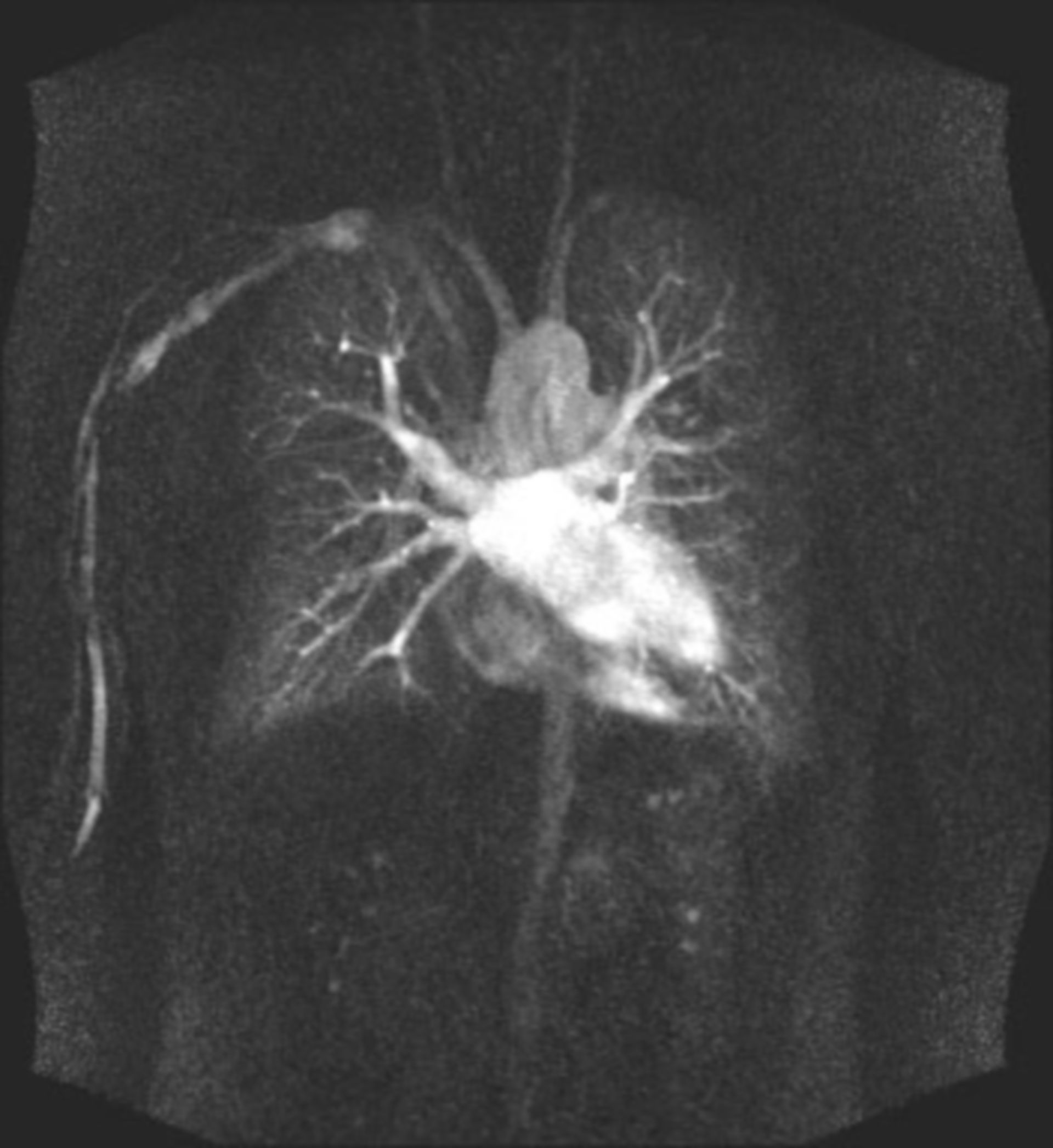 Röntgen Herz