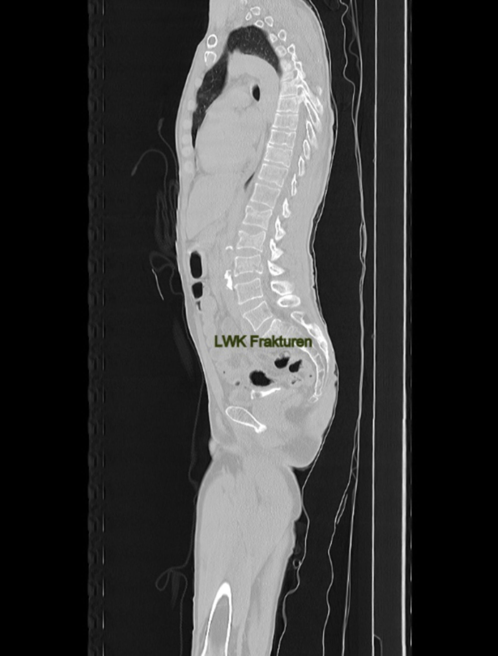 Whole body CT scan - Lumbar vertebra fractures - Polytrauma