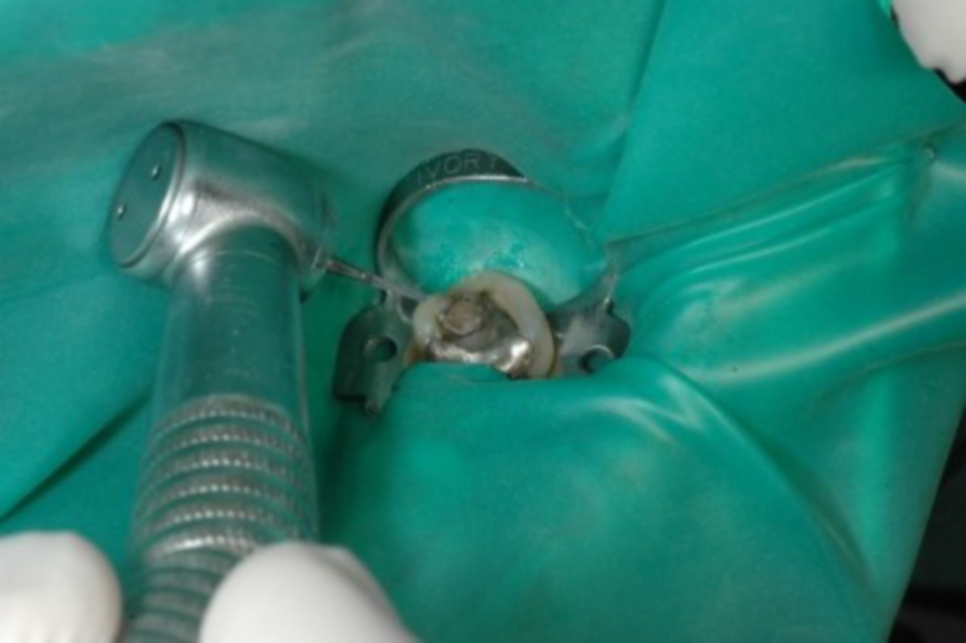 Removal of mercury amalgam filling (6/8)