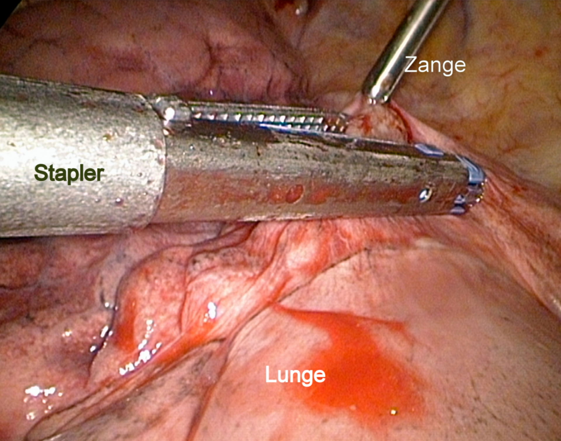 Thorakoskopie- Tumorresektion mittels Stapler