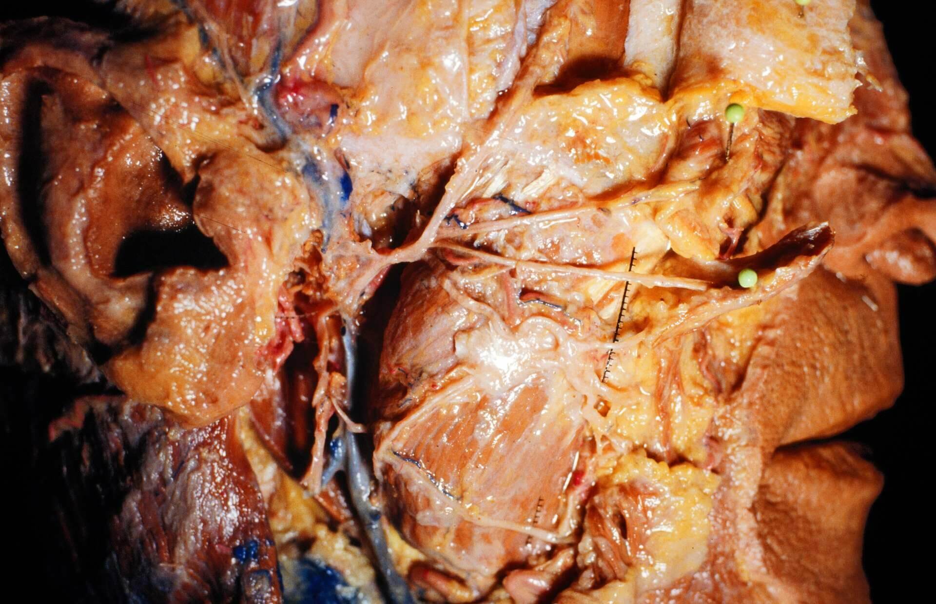 Nervus facialis