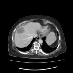 Leberabszess DocCheck Flexikon