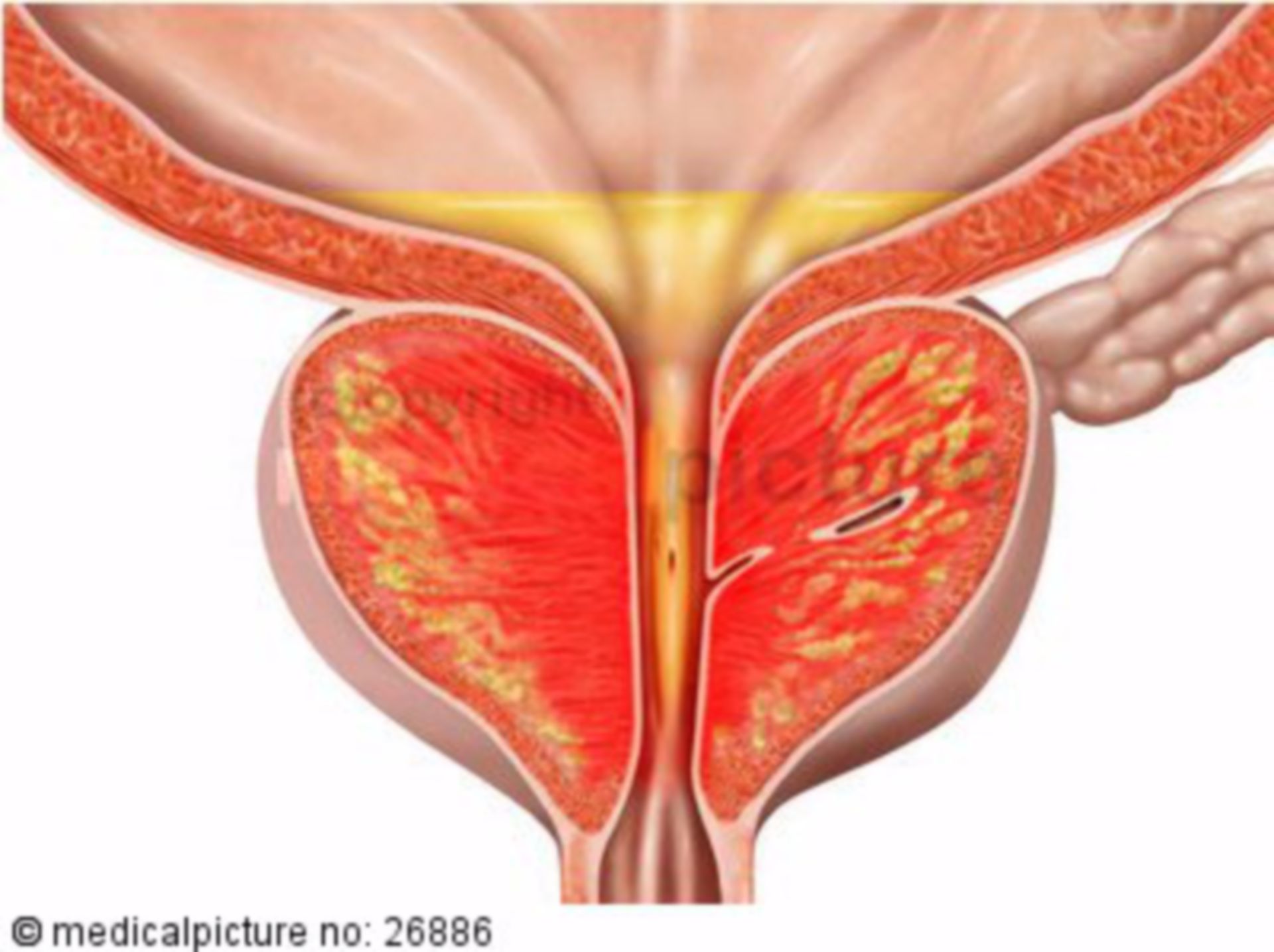 Inflamed prostate with urine retention