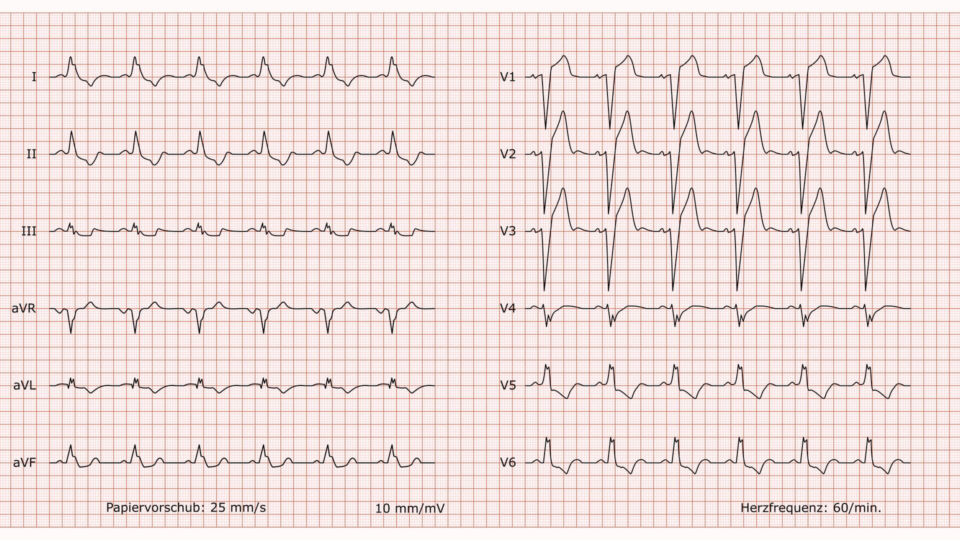 12-kanal-ekg-bei-komplettem-linksschenkelblock-doccheck