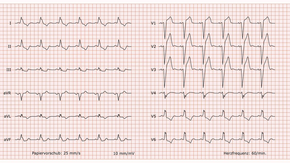 12-Kanal-EKG bei komplettem Linksschenkelblock